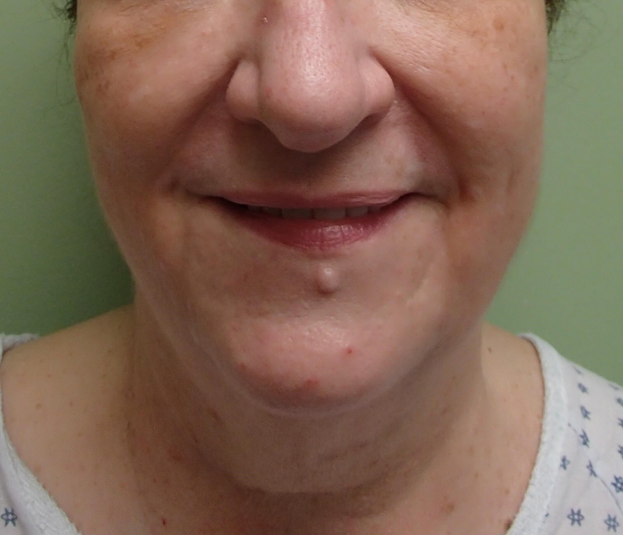 Necklift Before