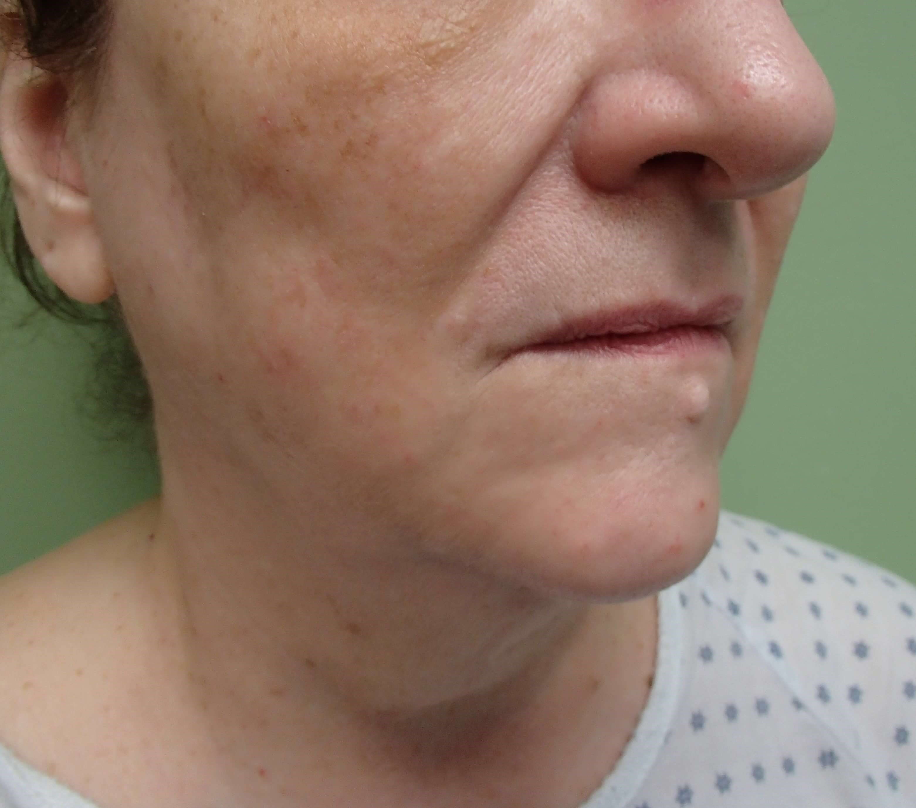 Necklift Before