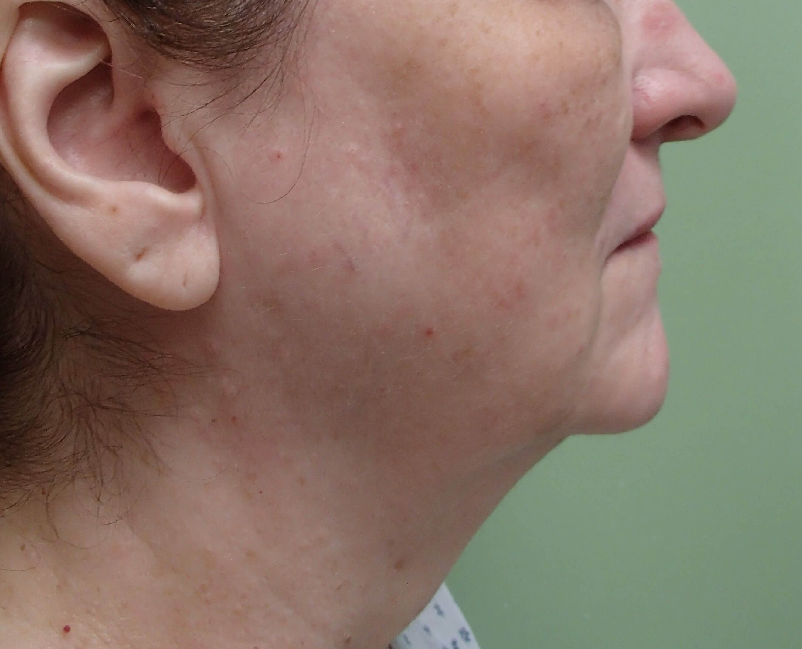 Necklift Before