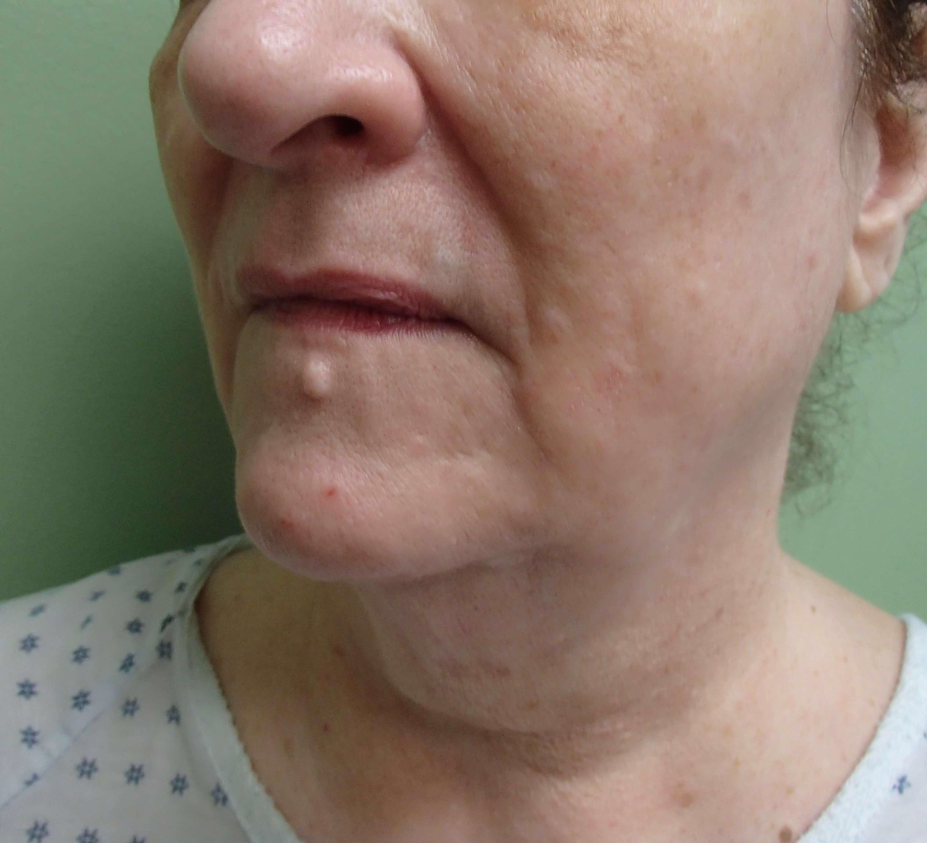 Necklift Before