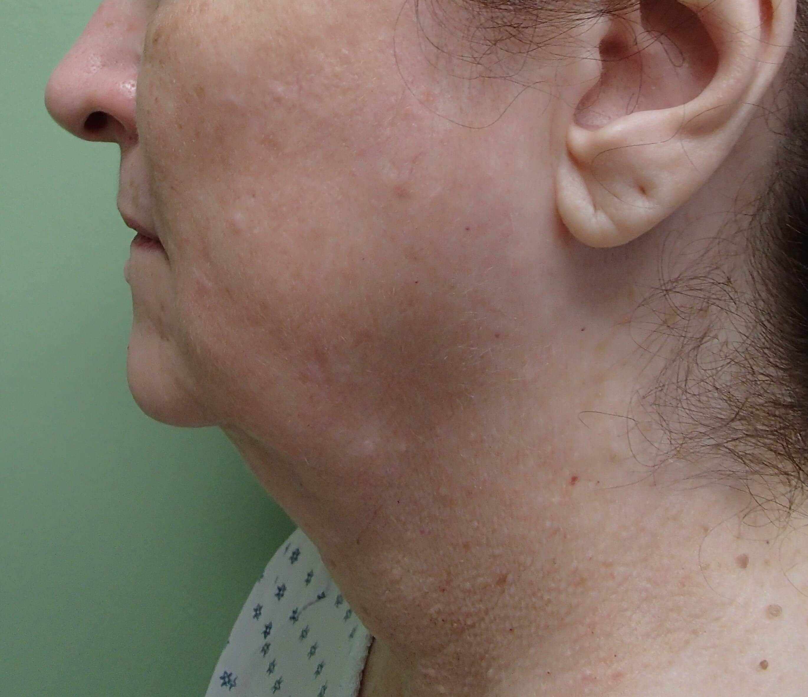 Necklift Before