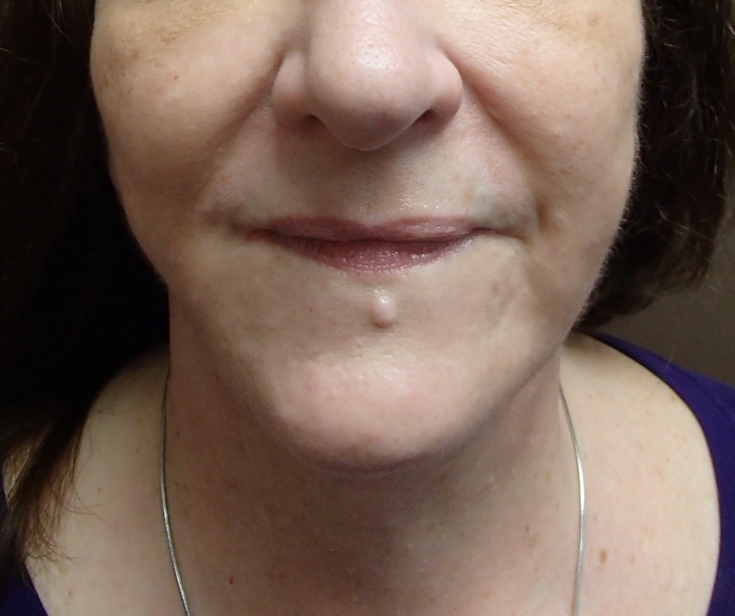 Necklift After