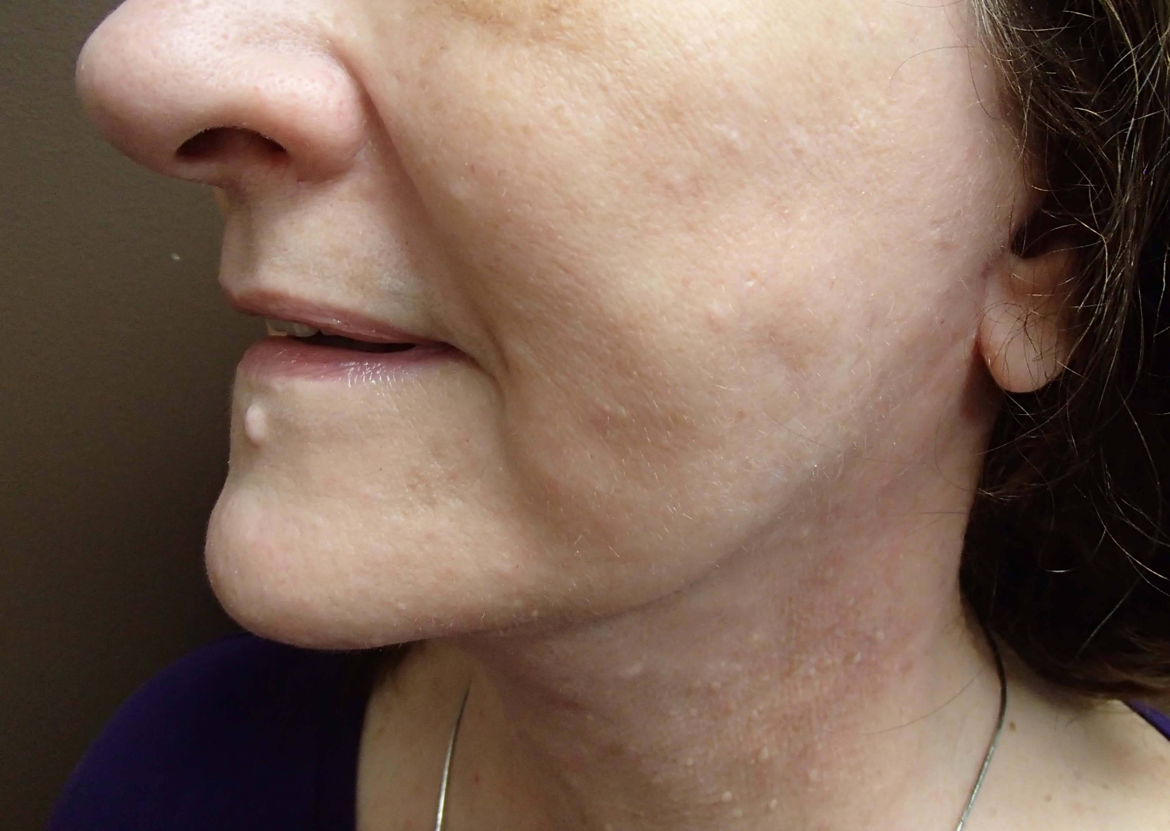 Necklift After
