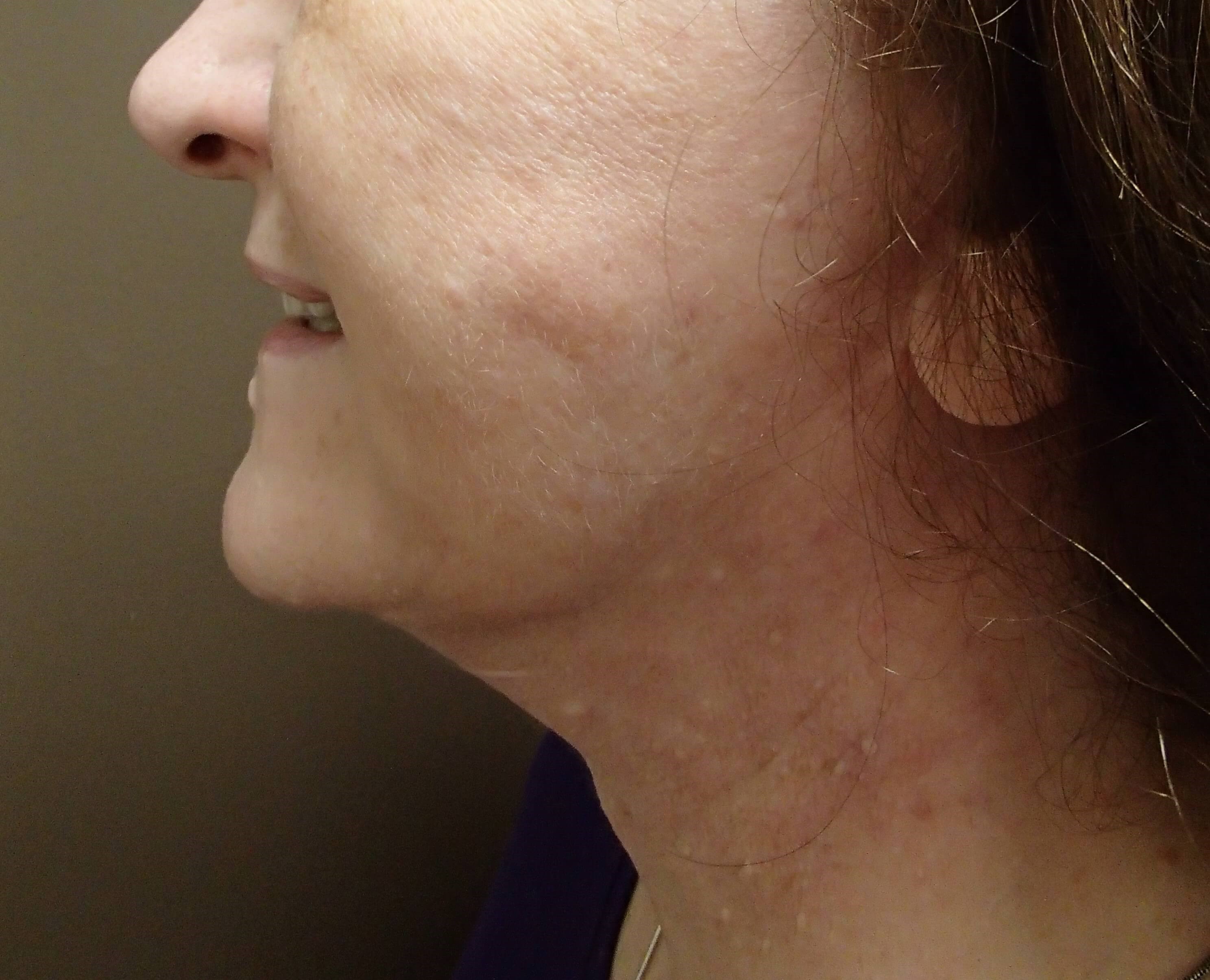 Necklift After