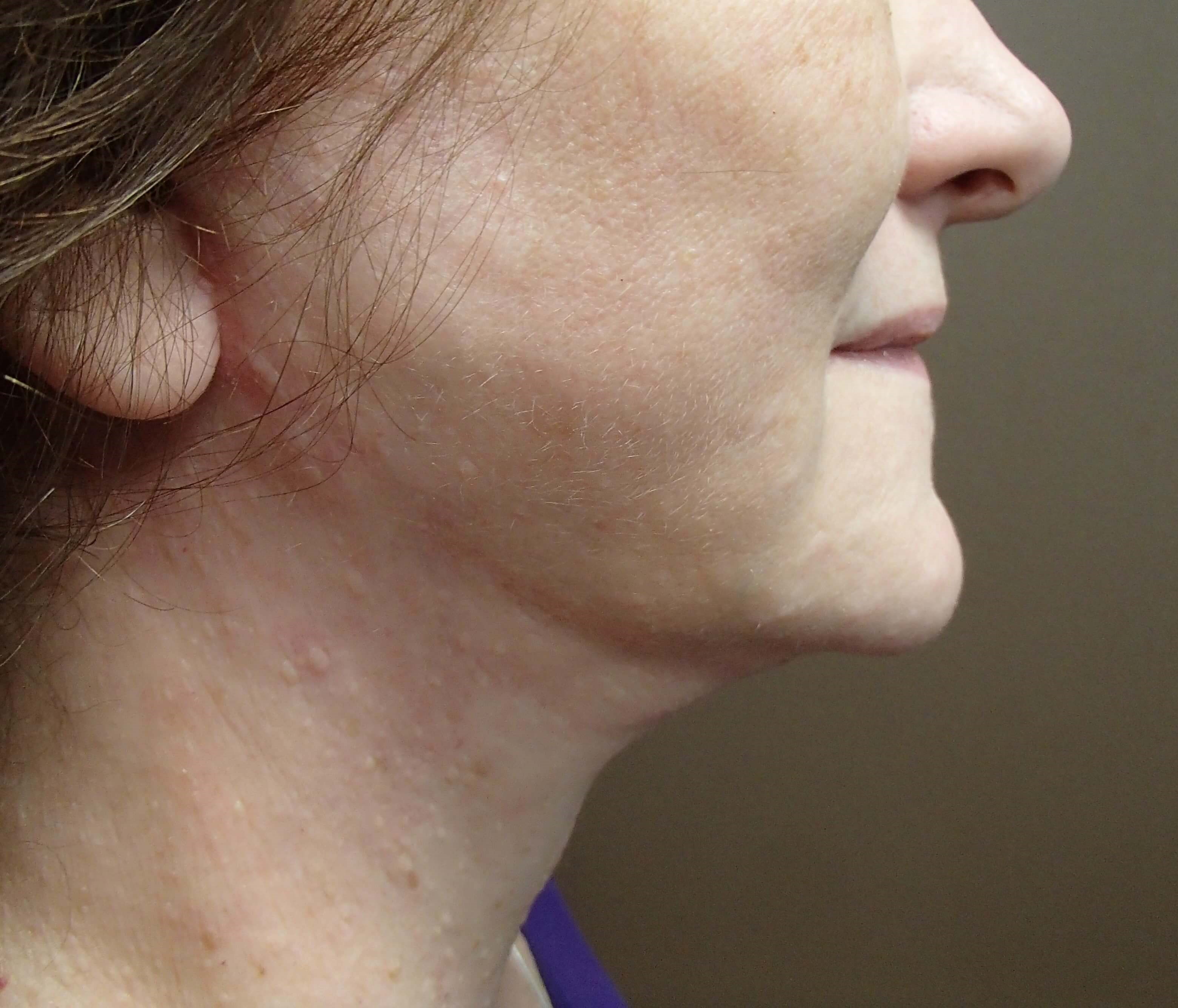 Necklift After