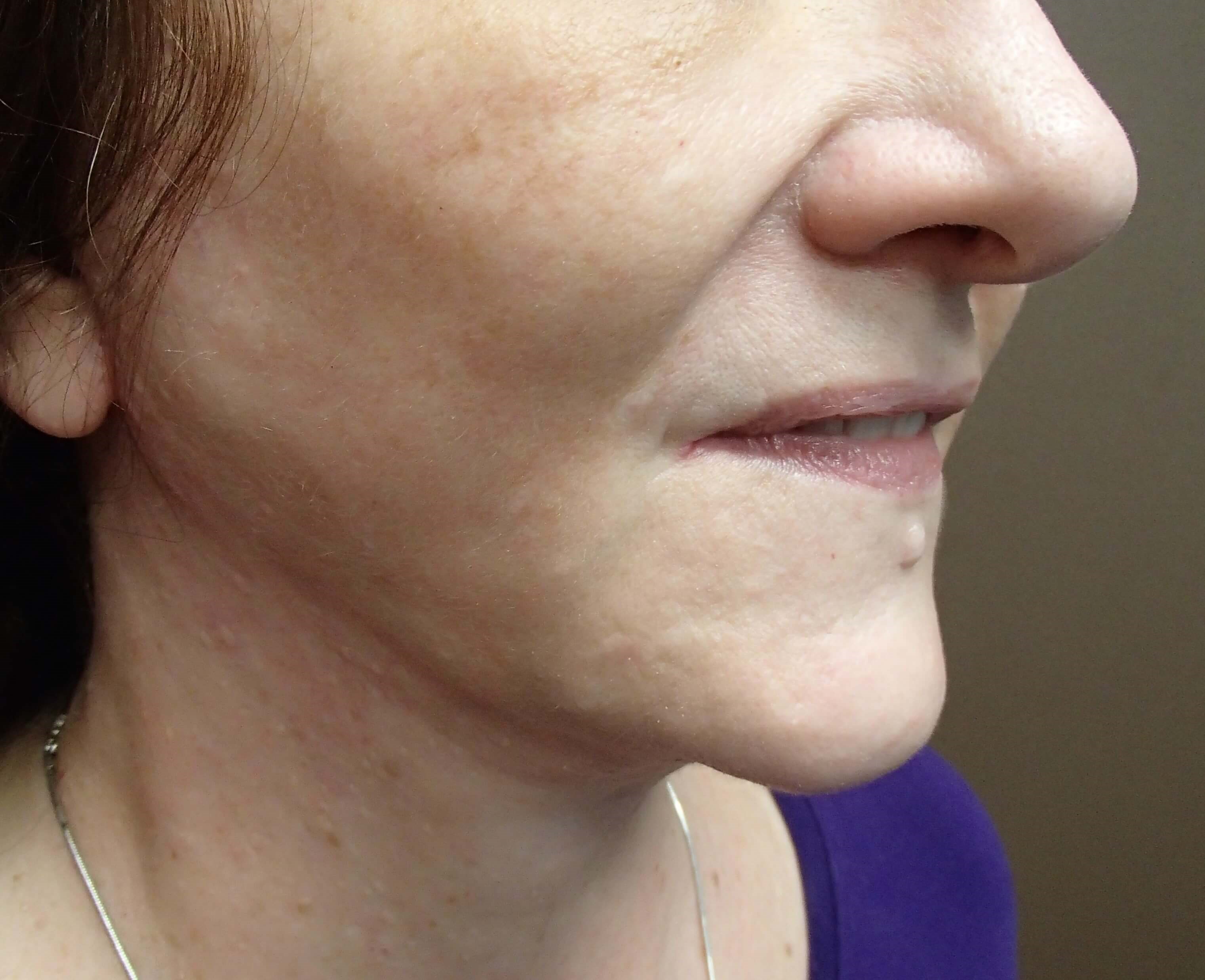 Necklift After