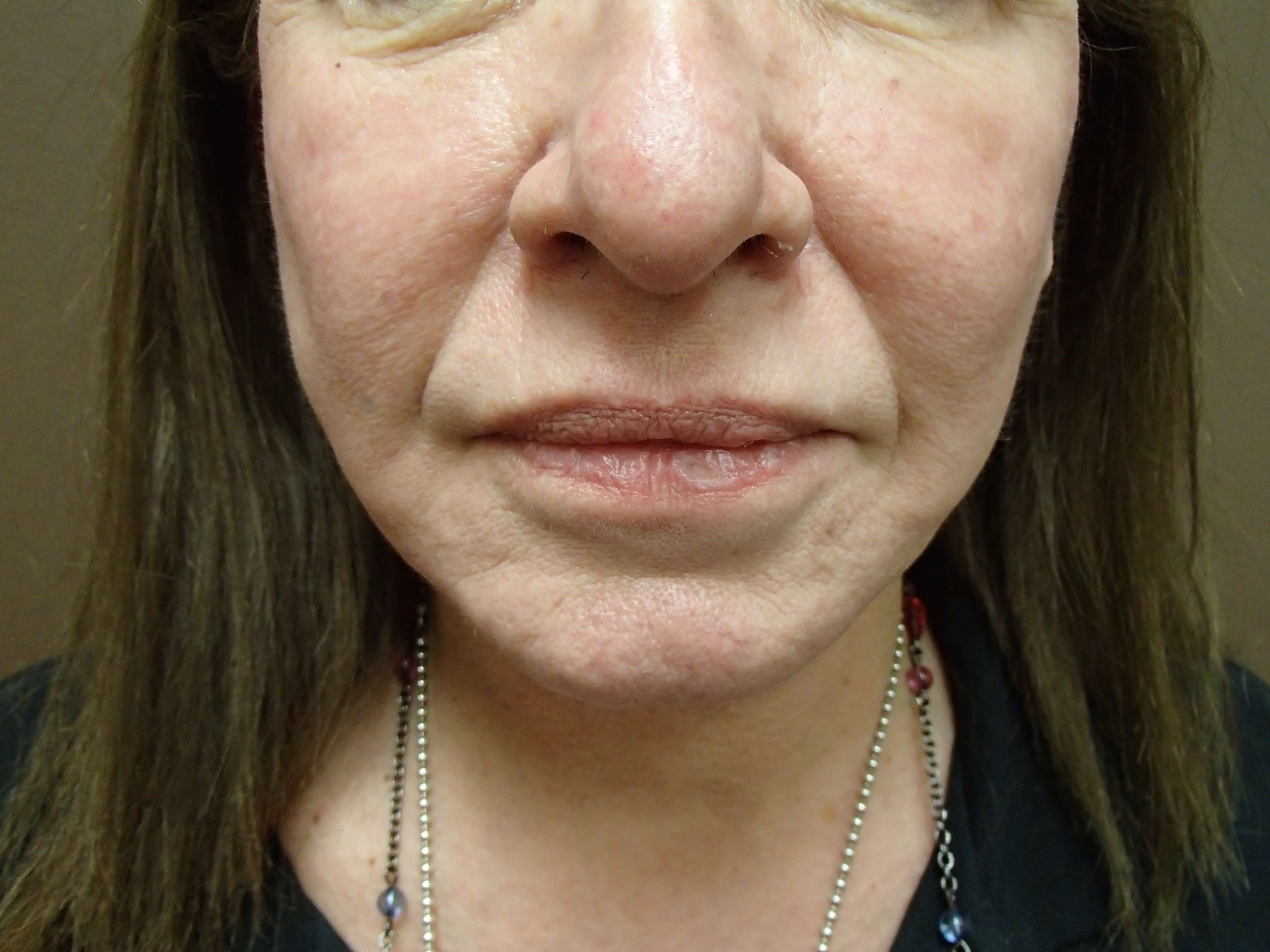 Necklift After