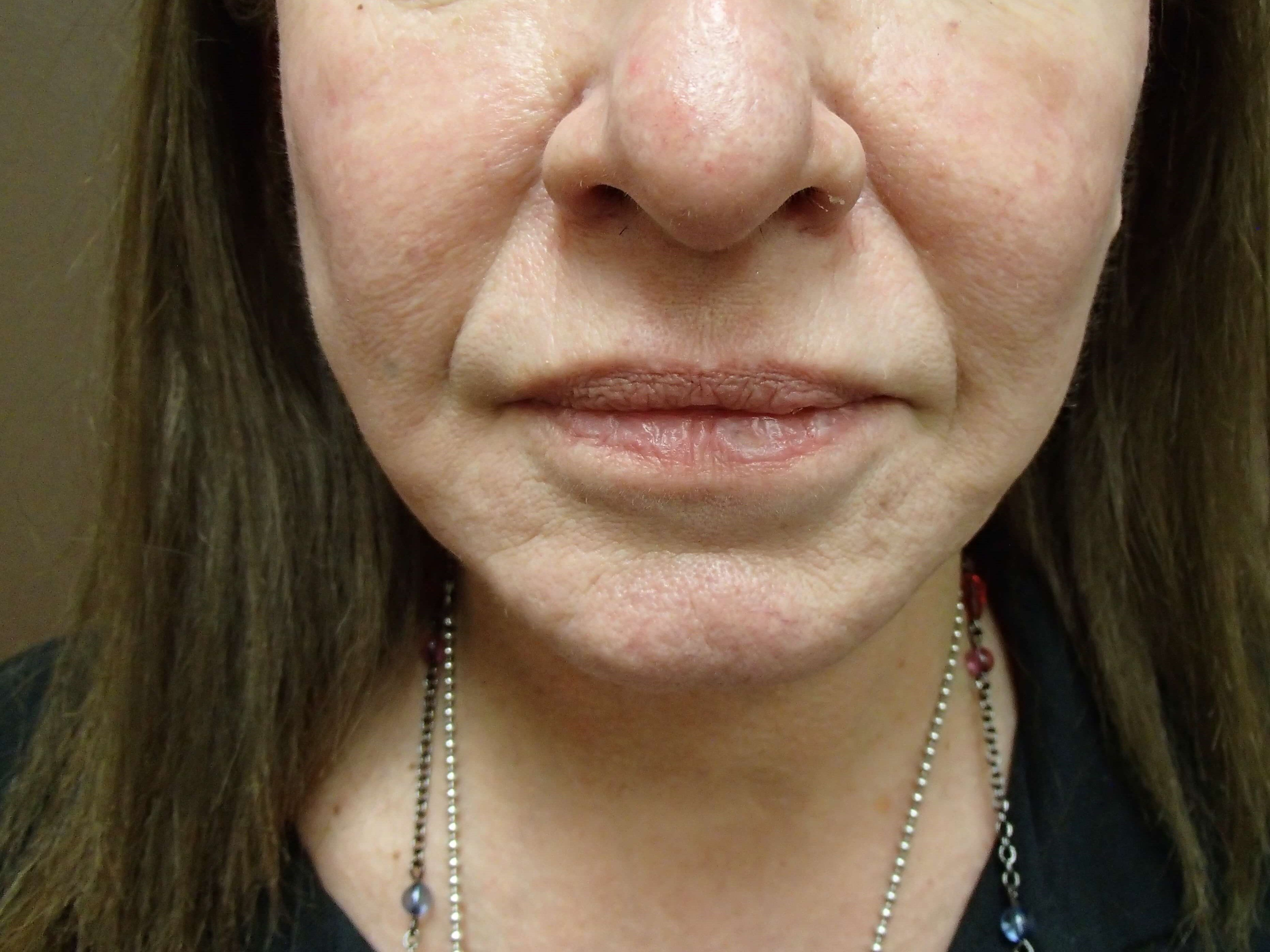 Necklift After