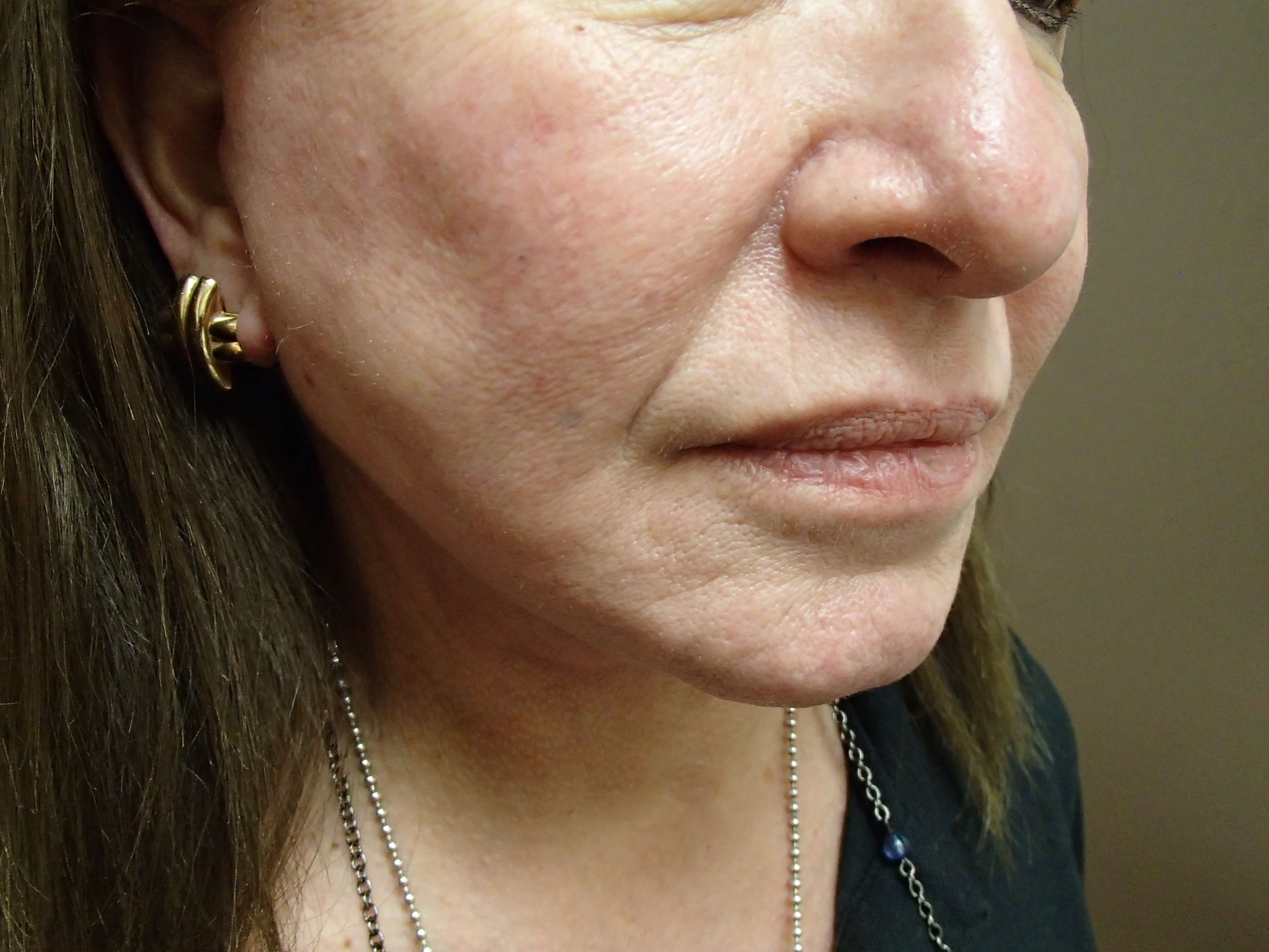 Necklift After