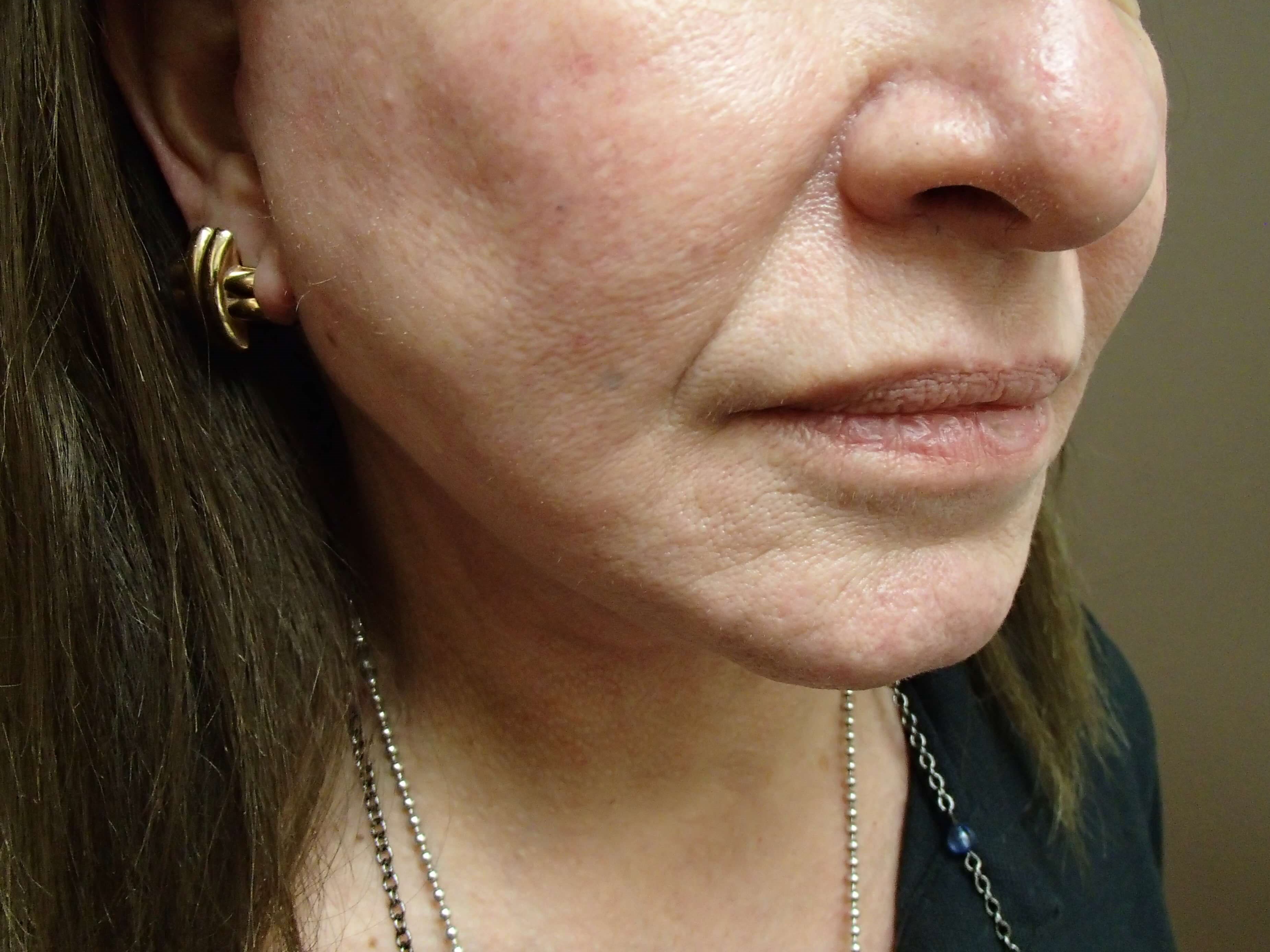 Necklift After