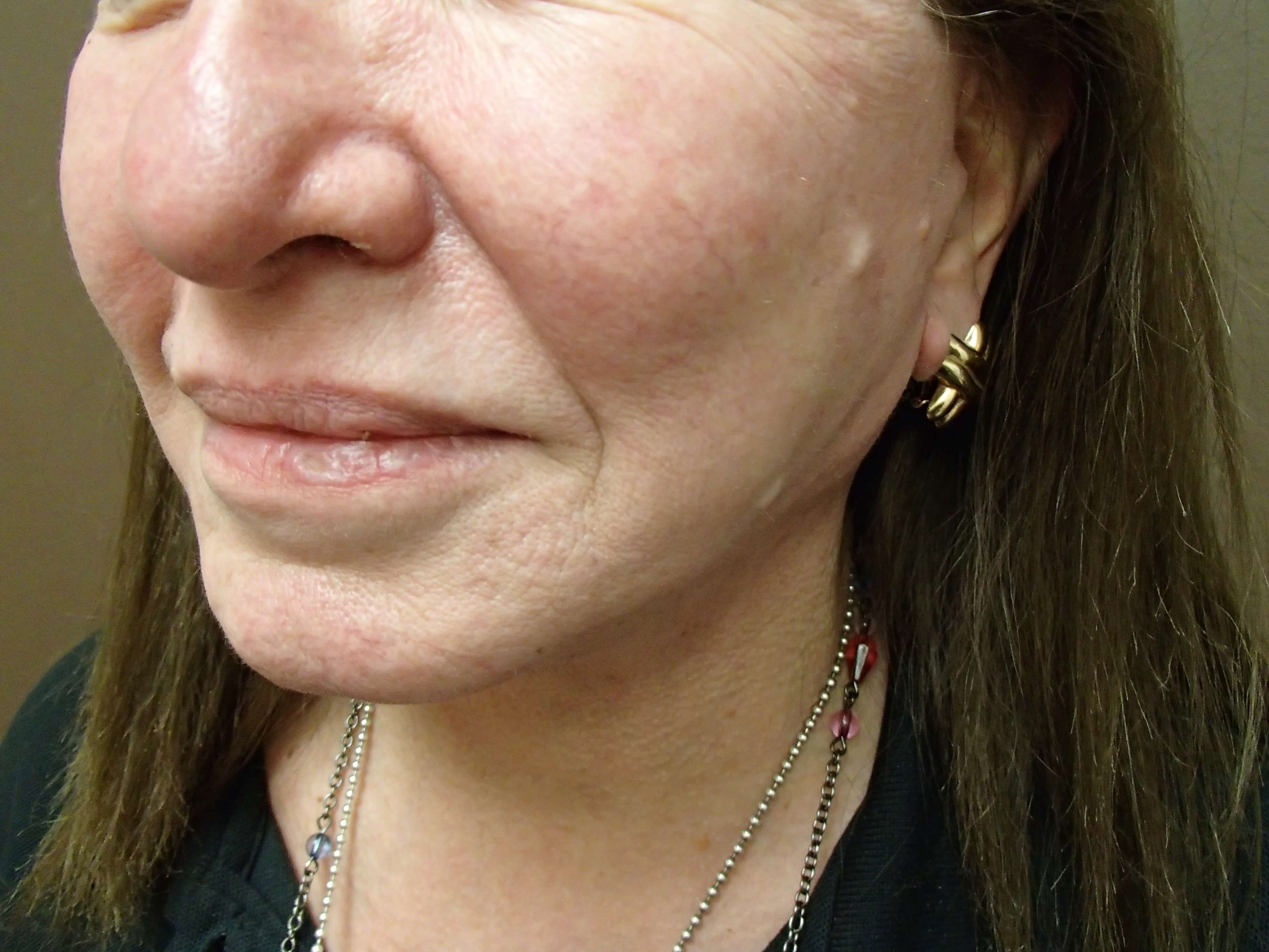 Necklift After