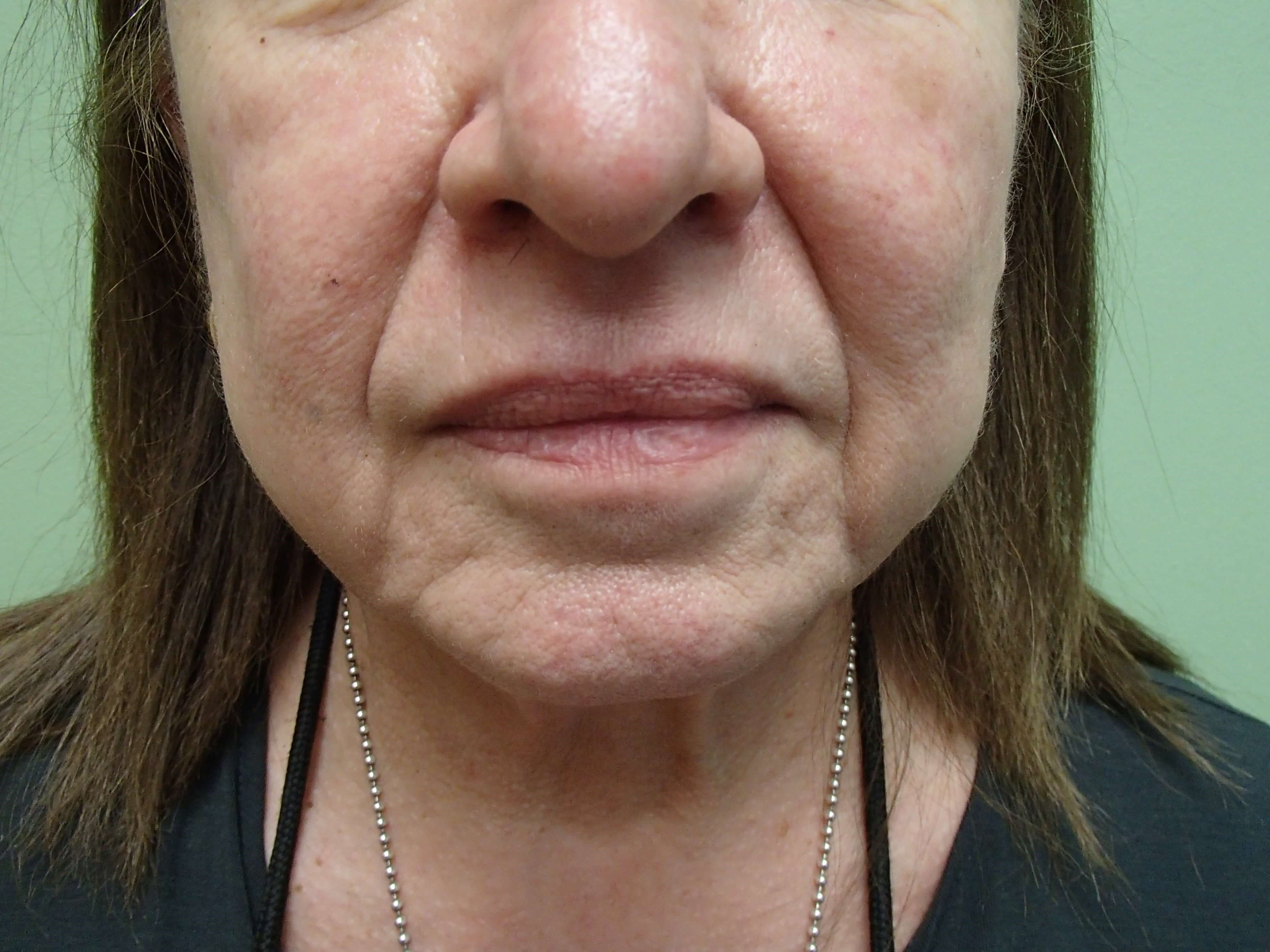 Necklift Before
