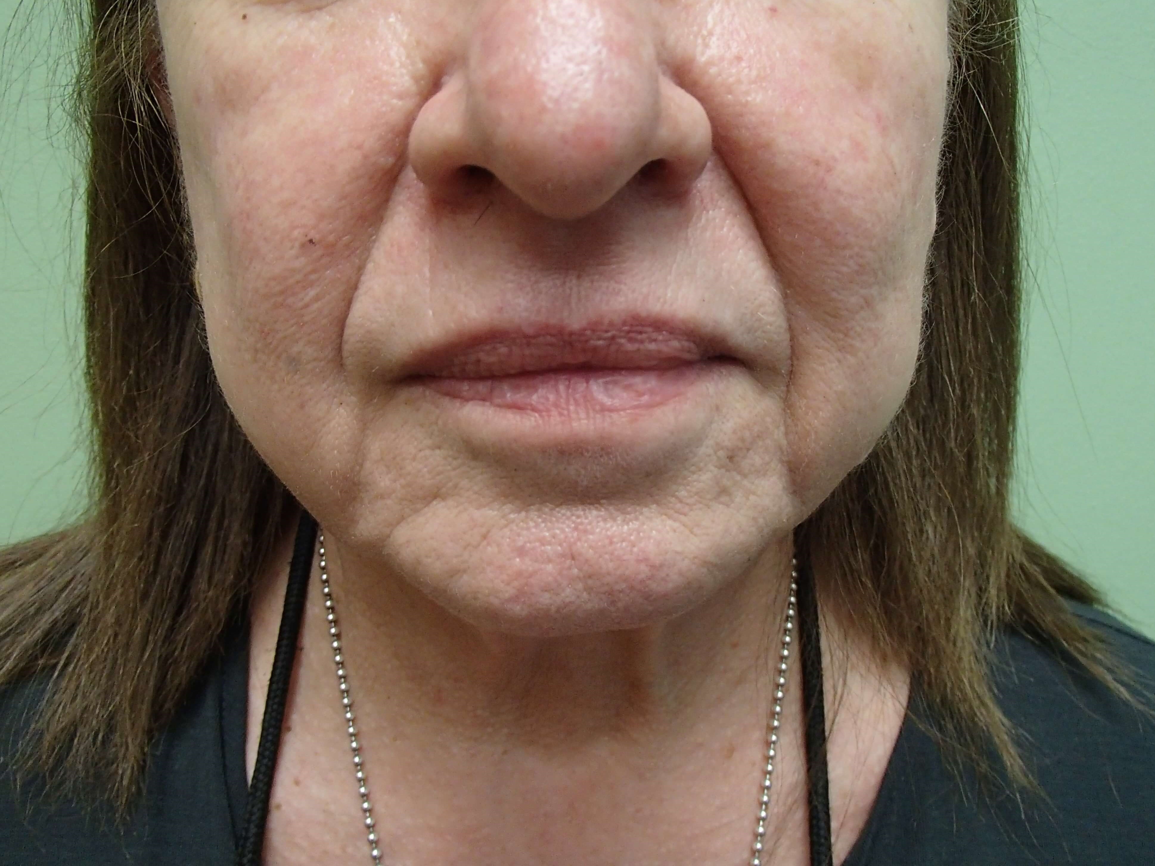 Necklift Before