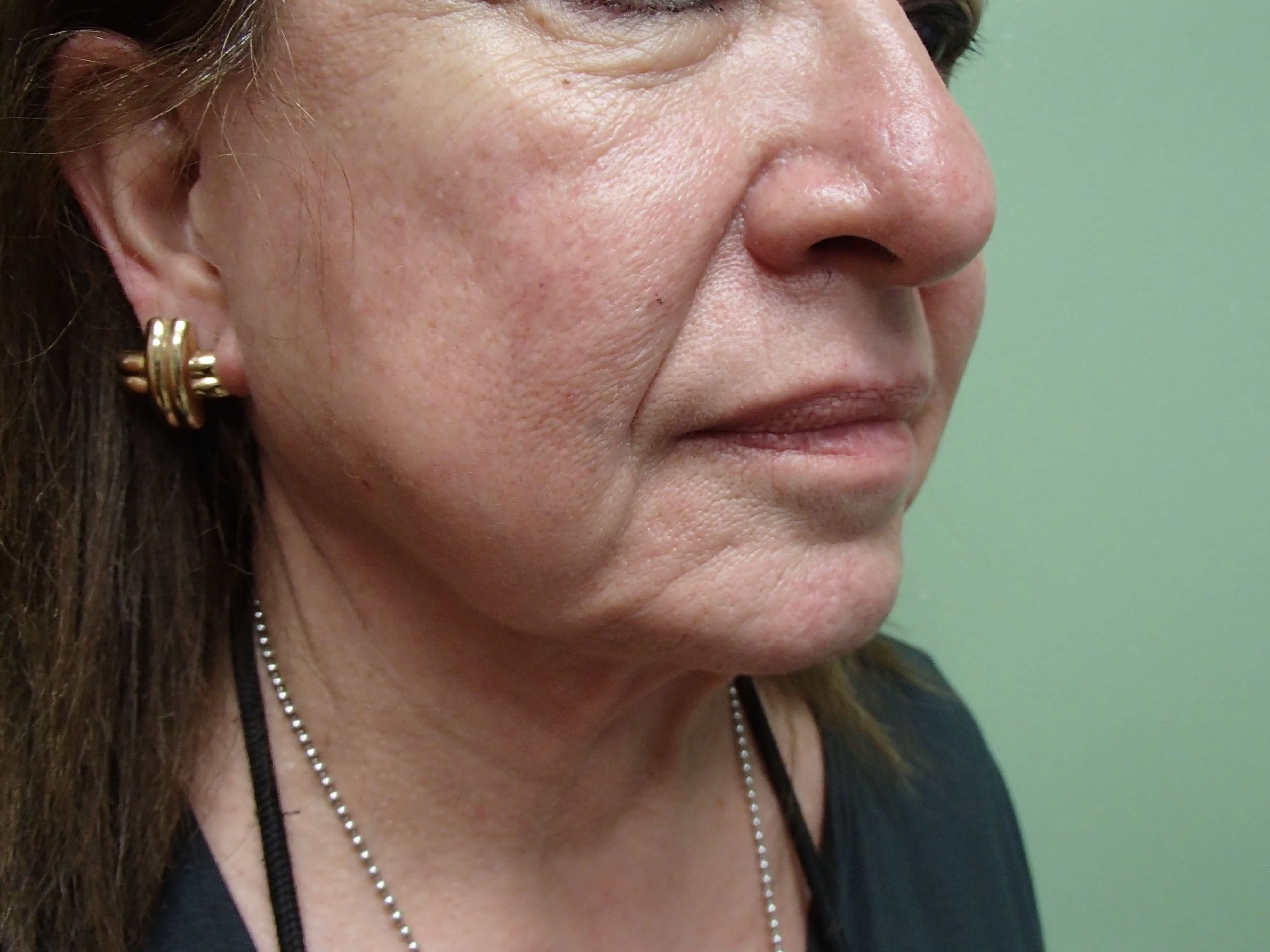 Necklift Before