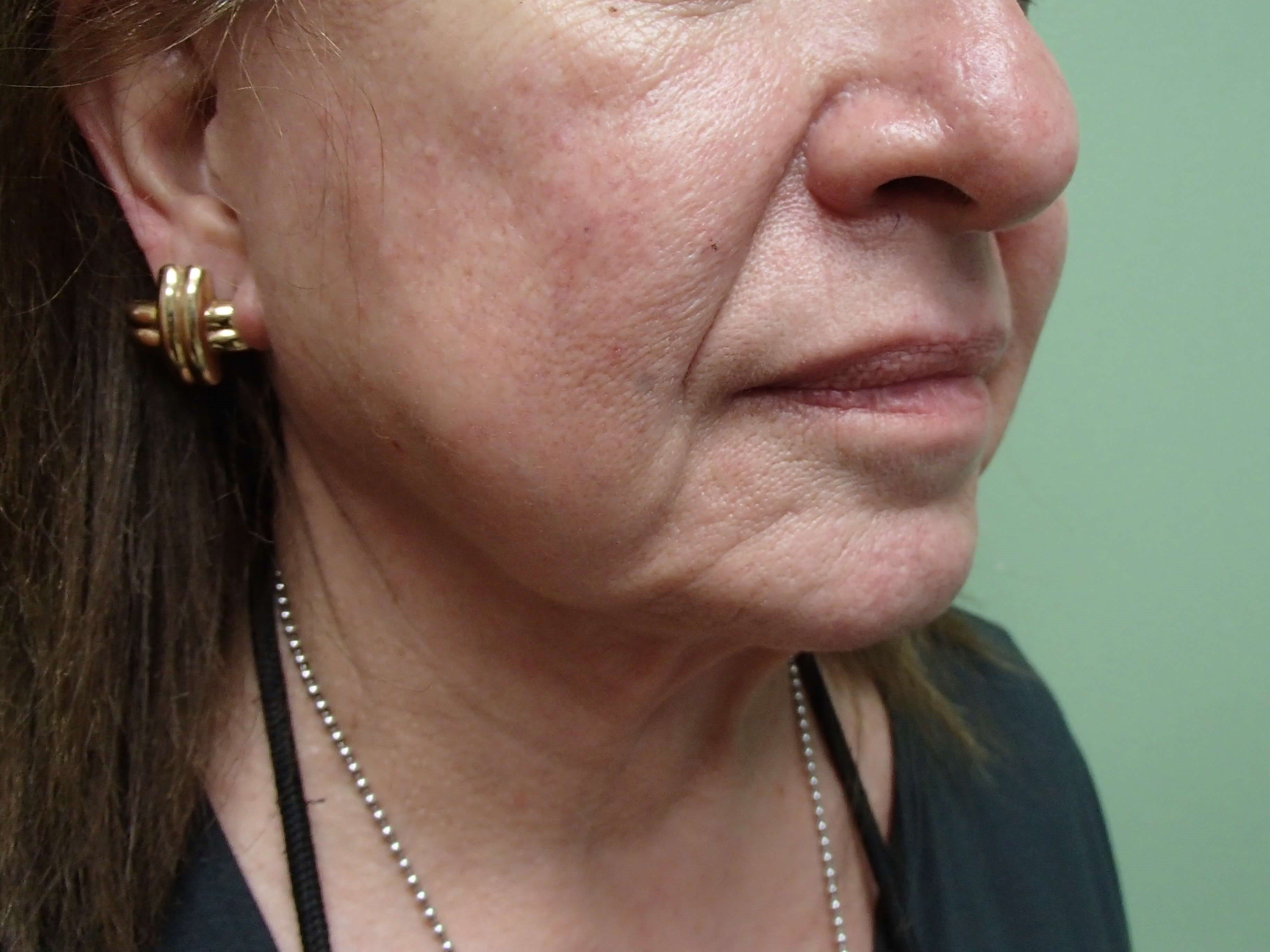 Necklift Before