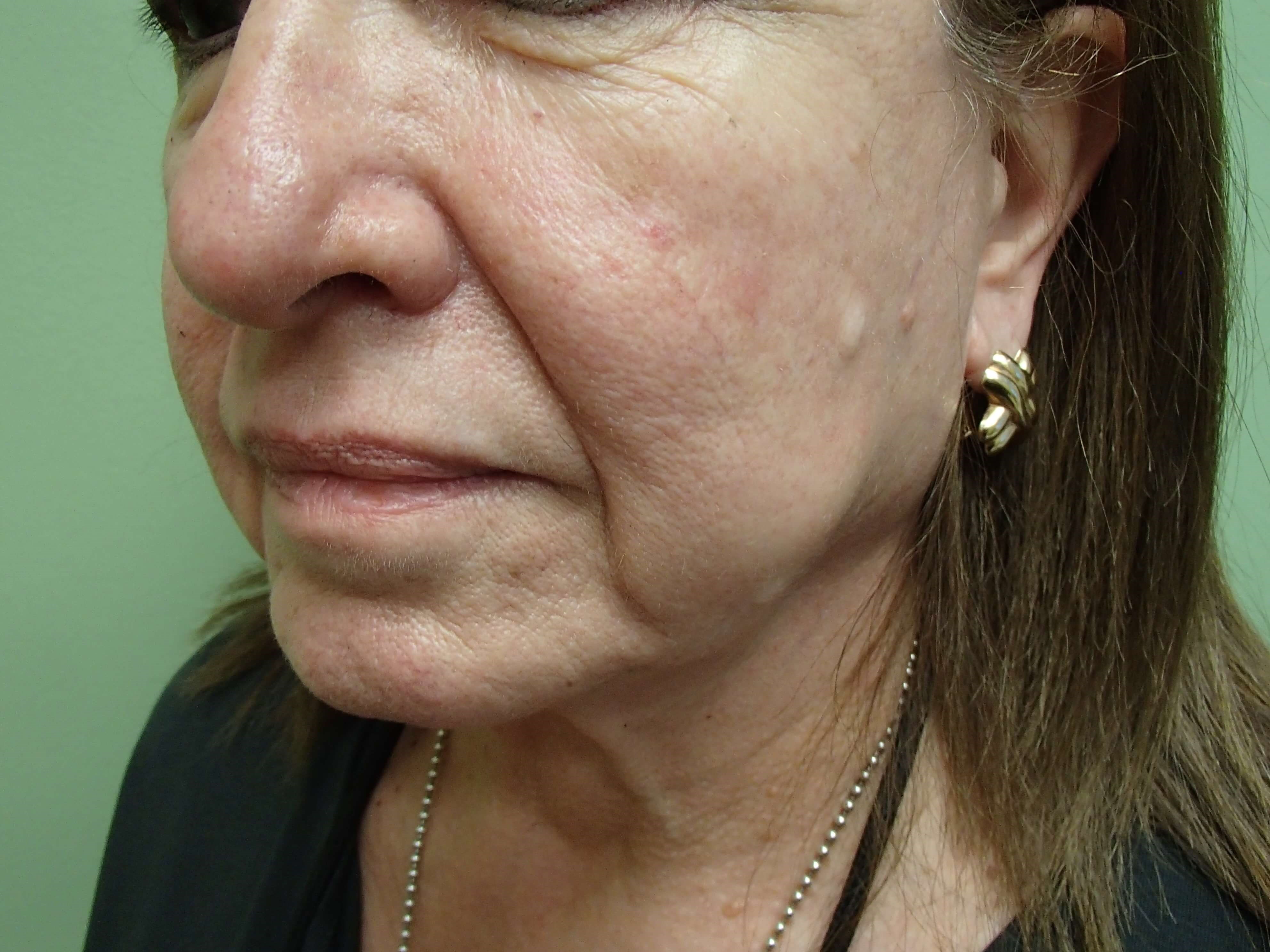 Necklift Before