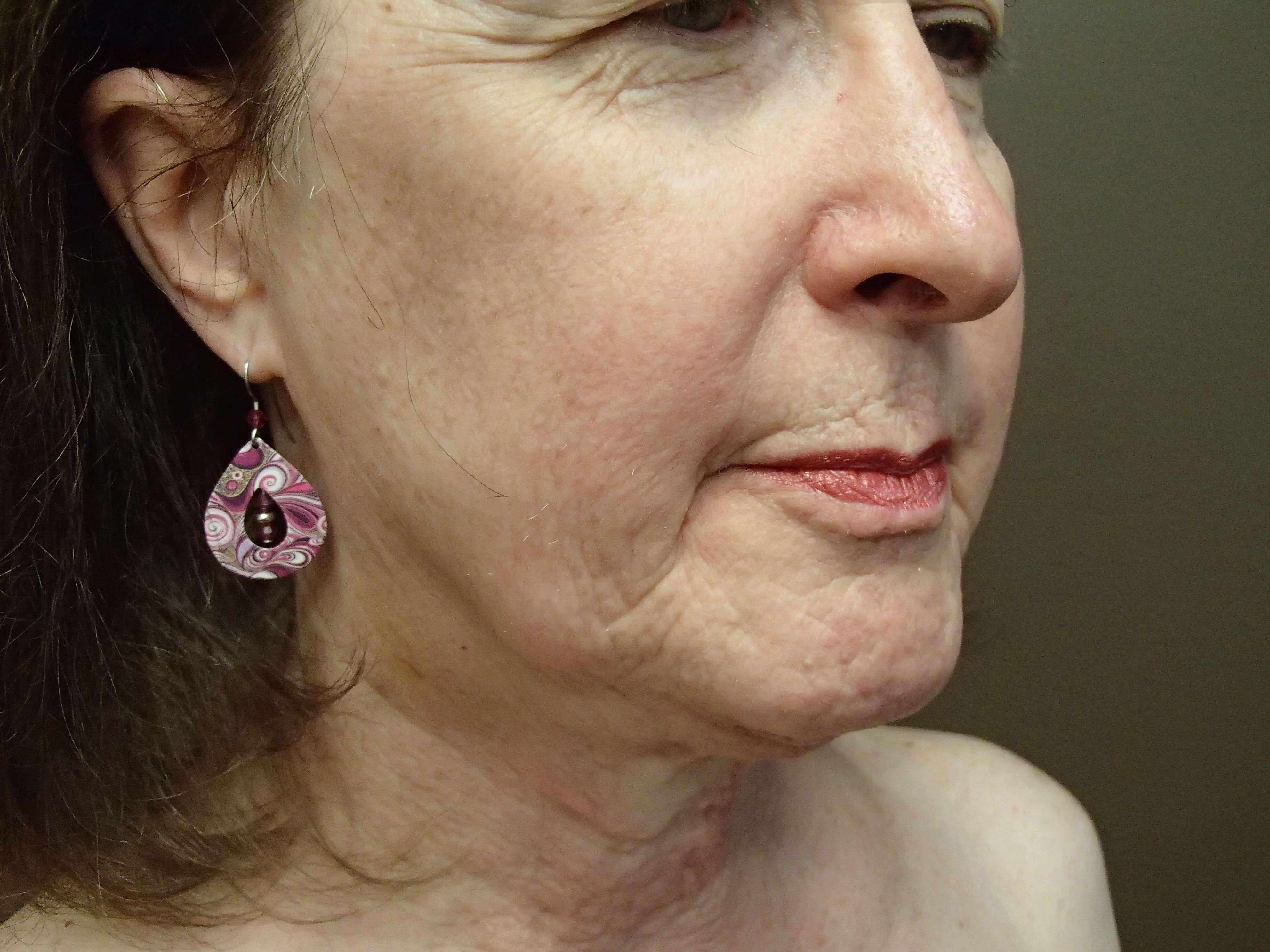 Necklift Before