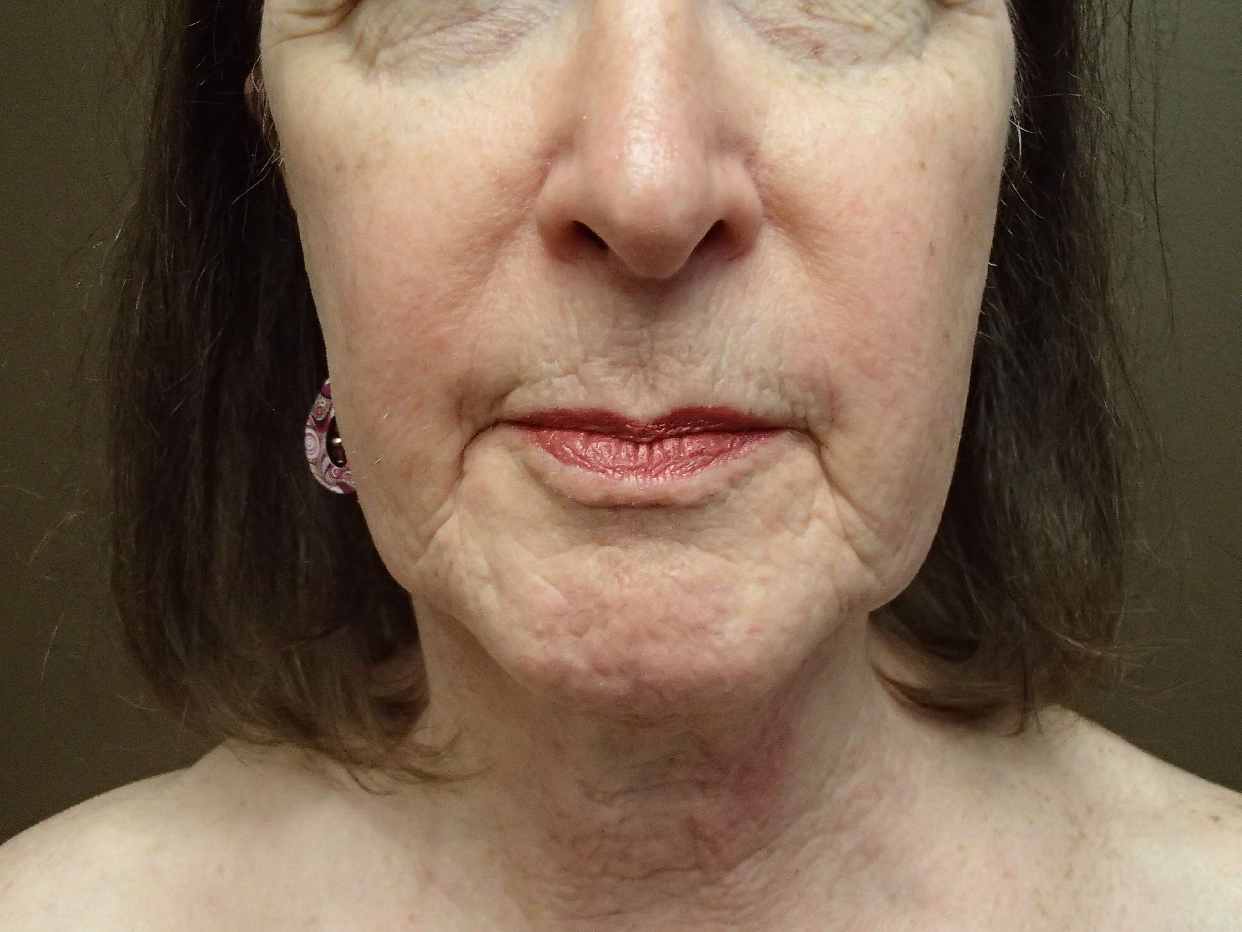 Necklift Before