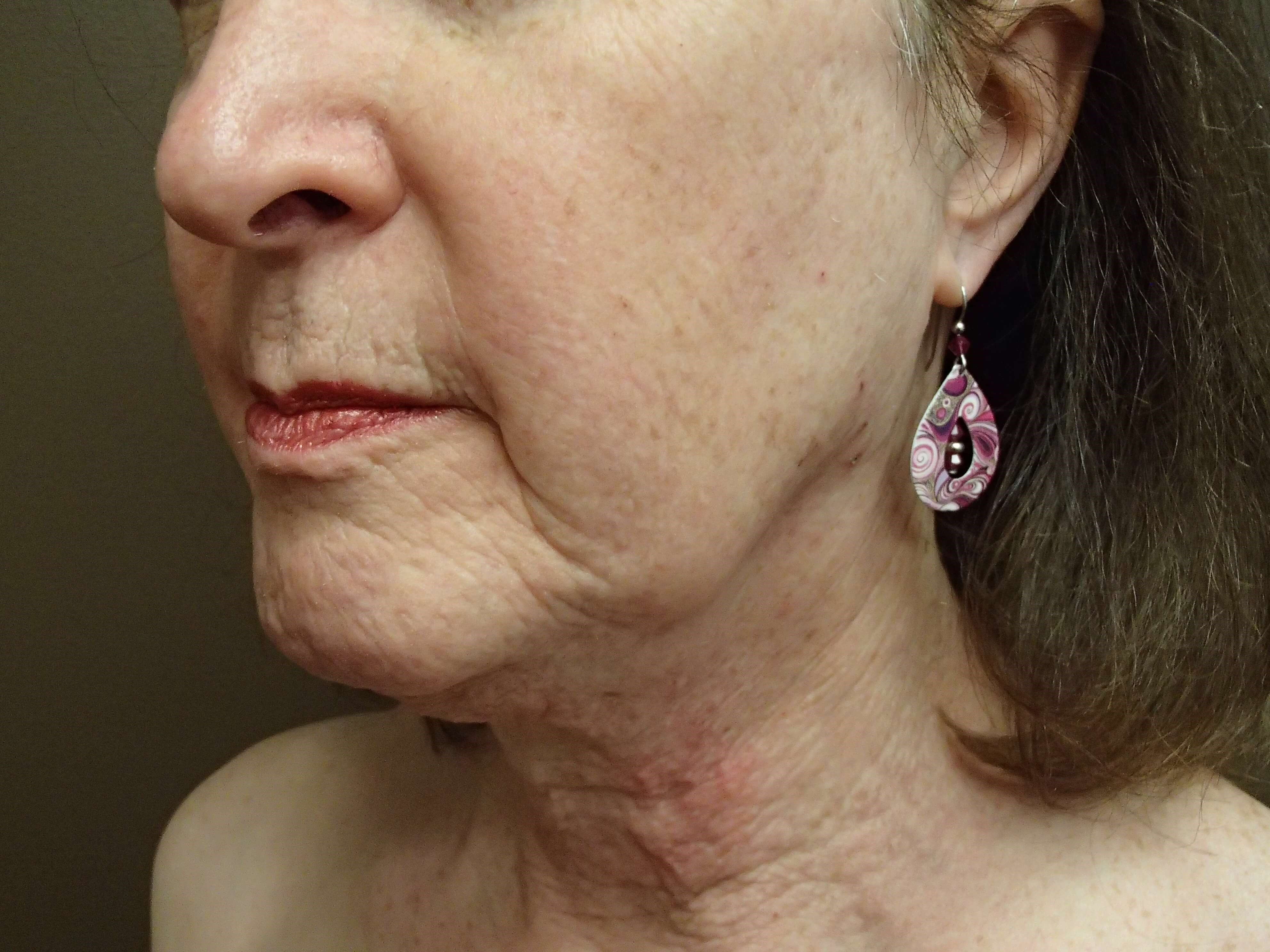 Necklift Before