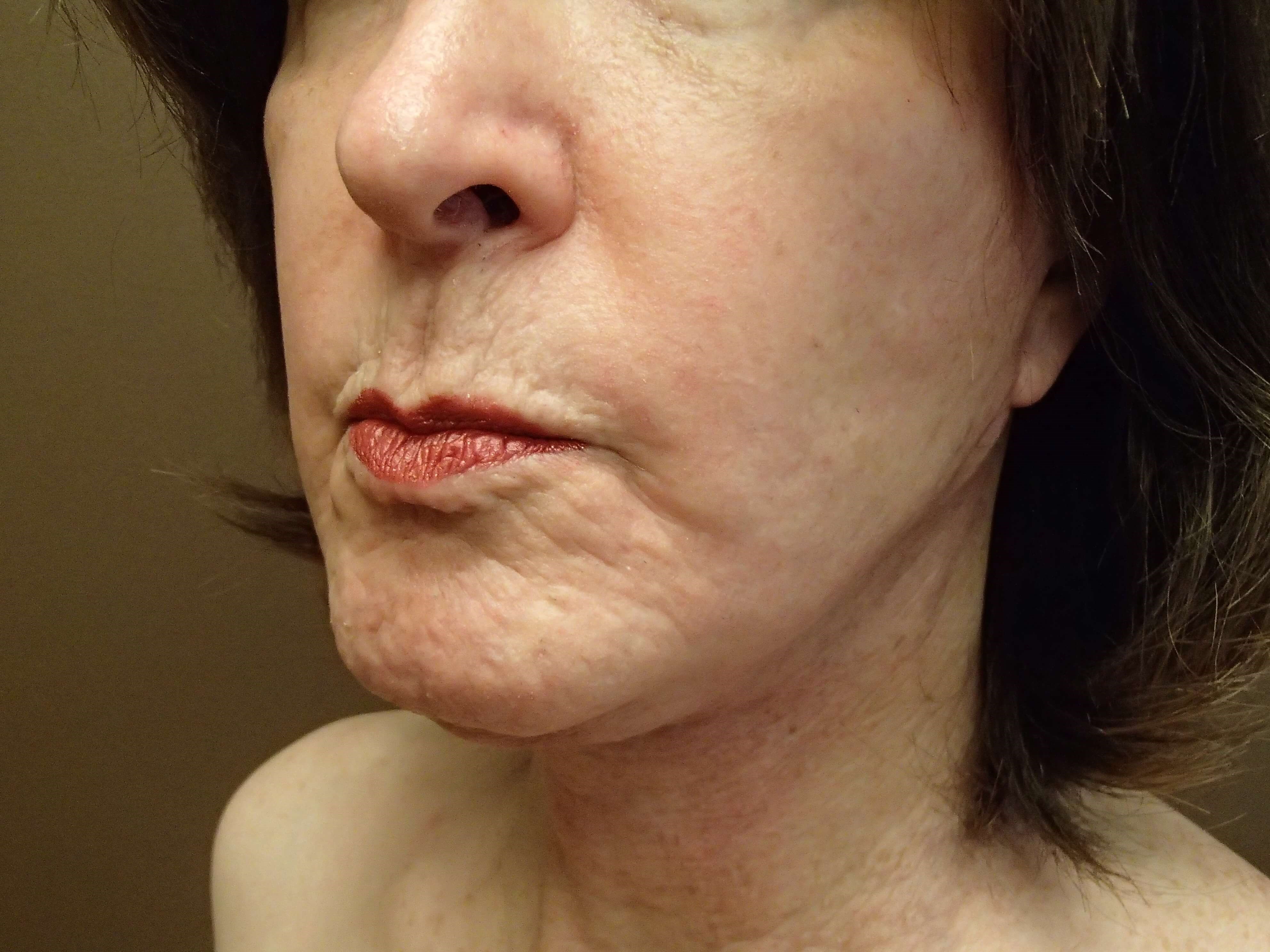Necklift After