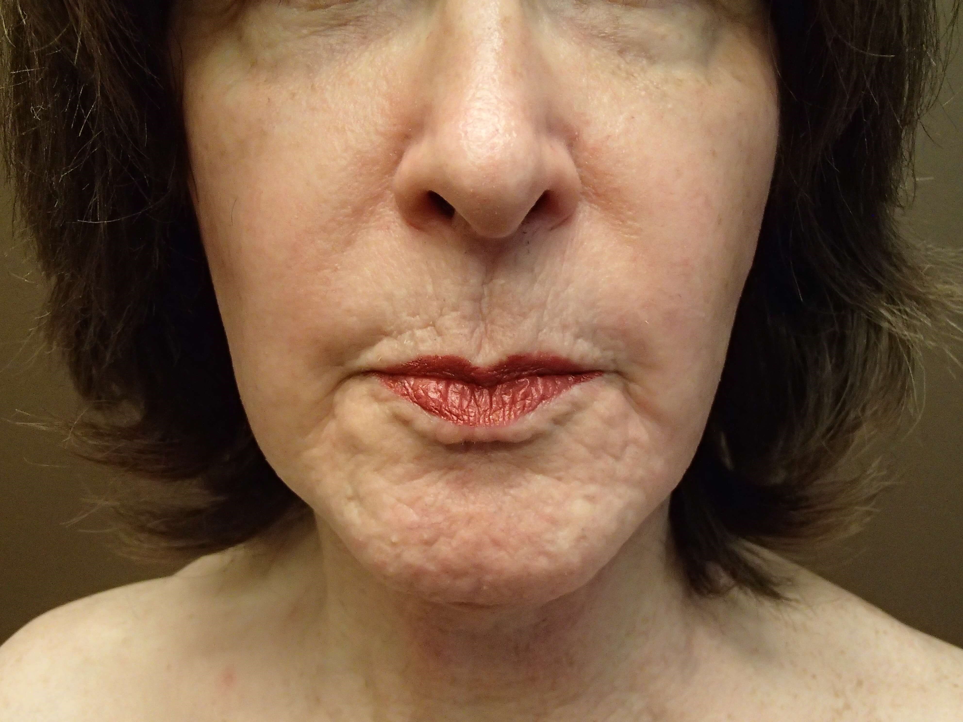 Necklift After