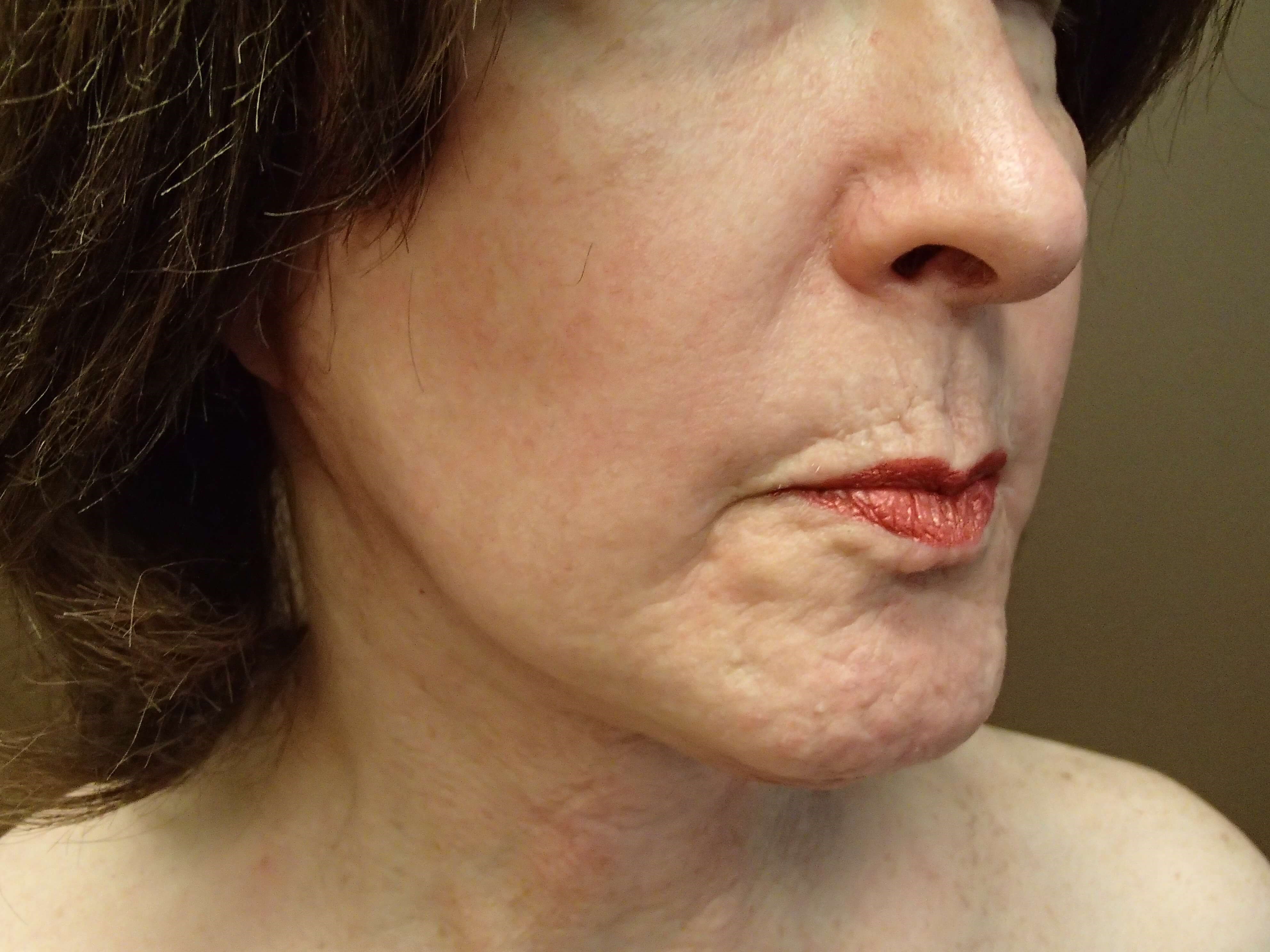 Necklift After