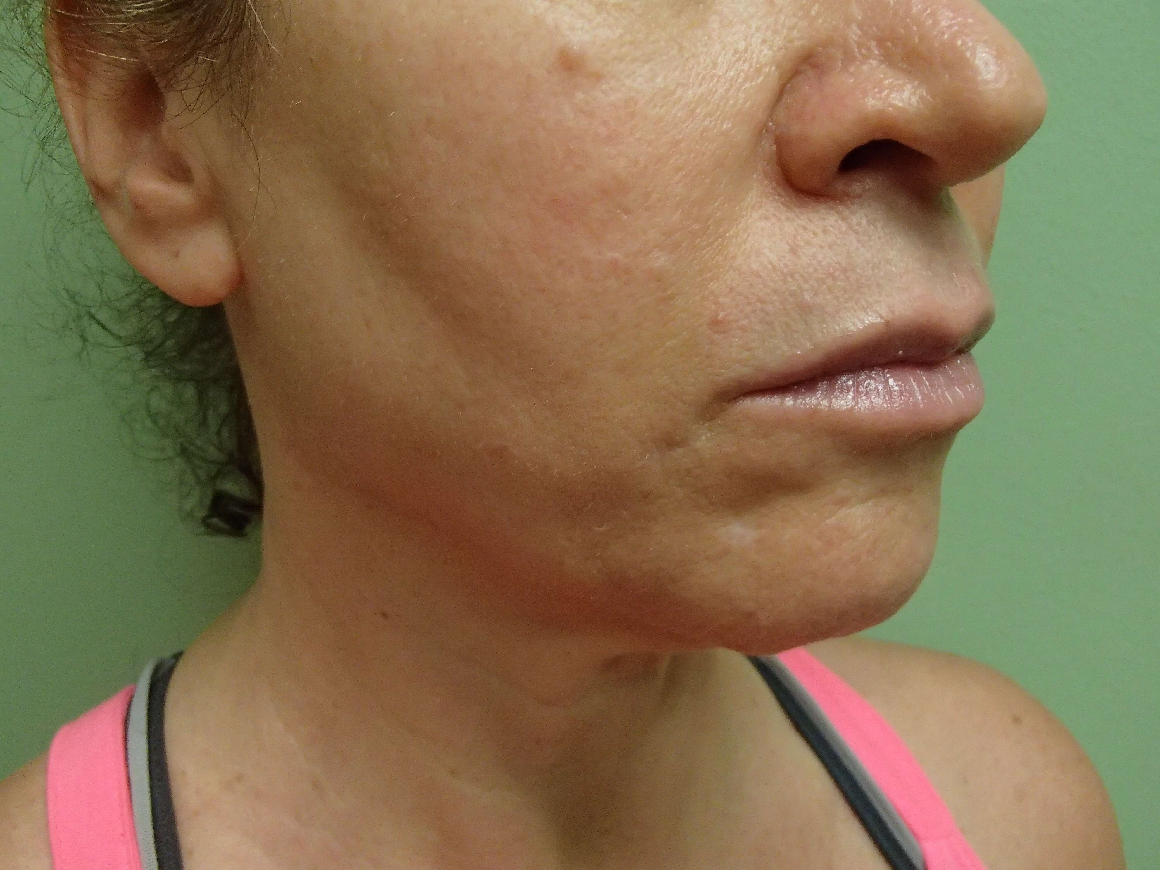 Necklift Before