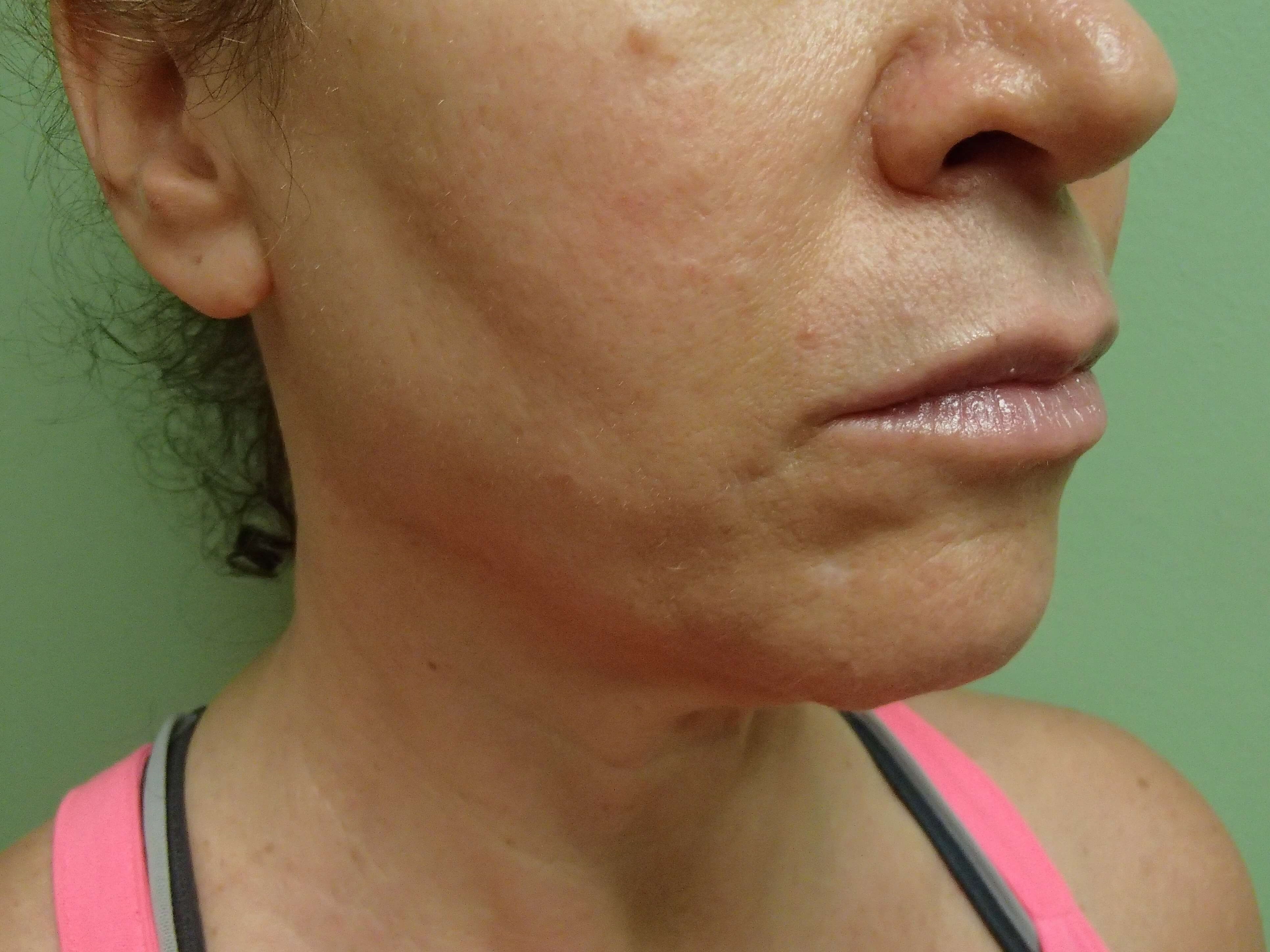 Necklift Before