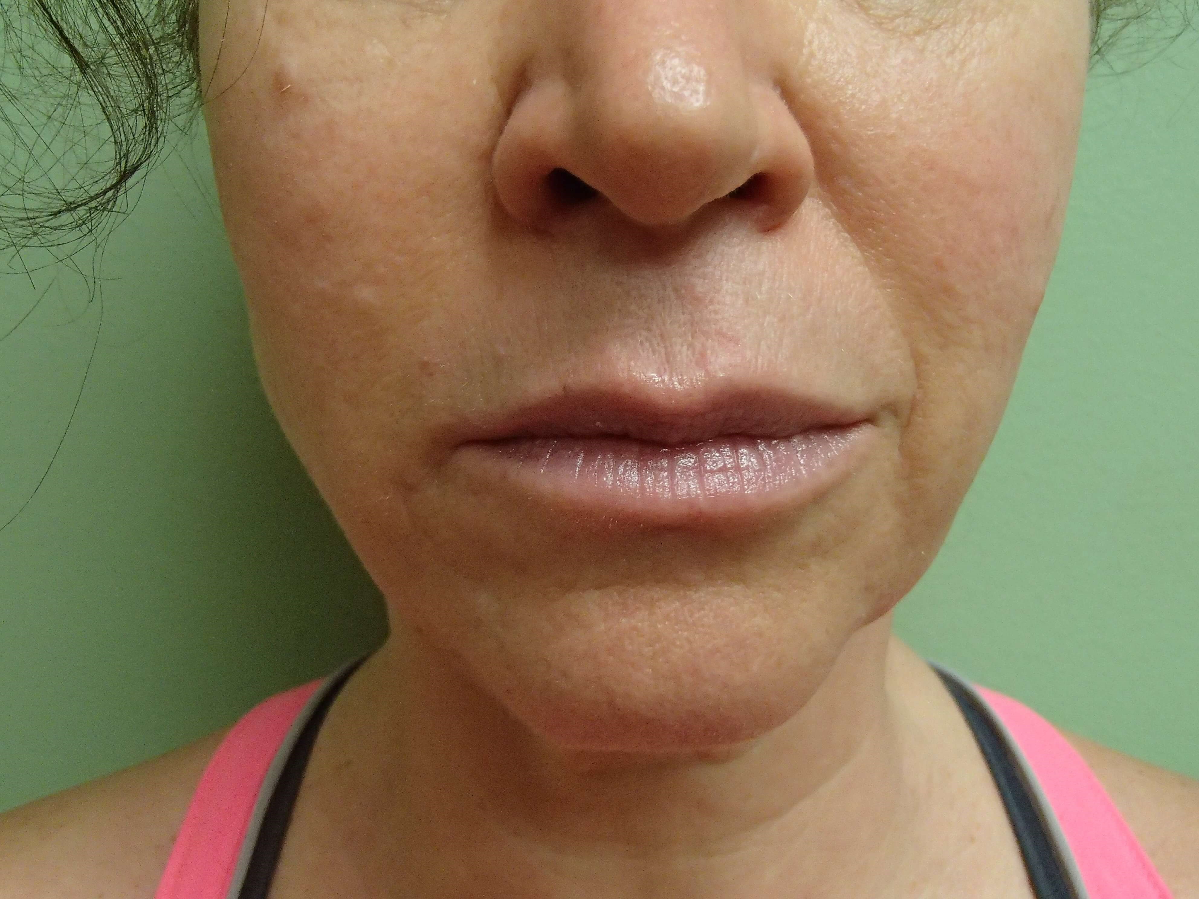 Necklift Before