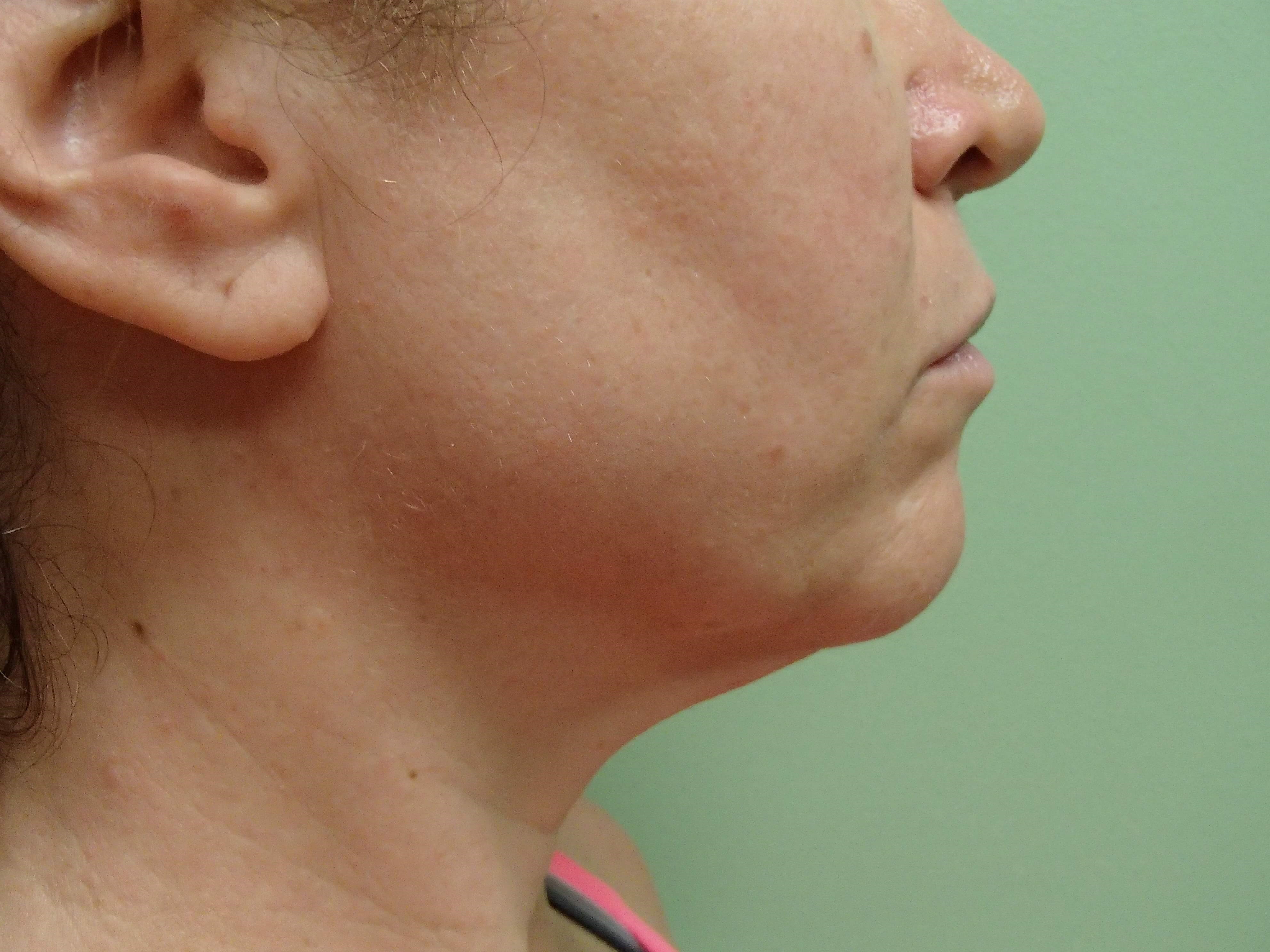 Necklift Before