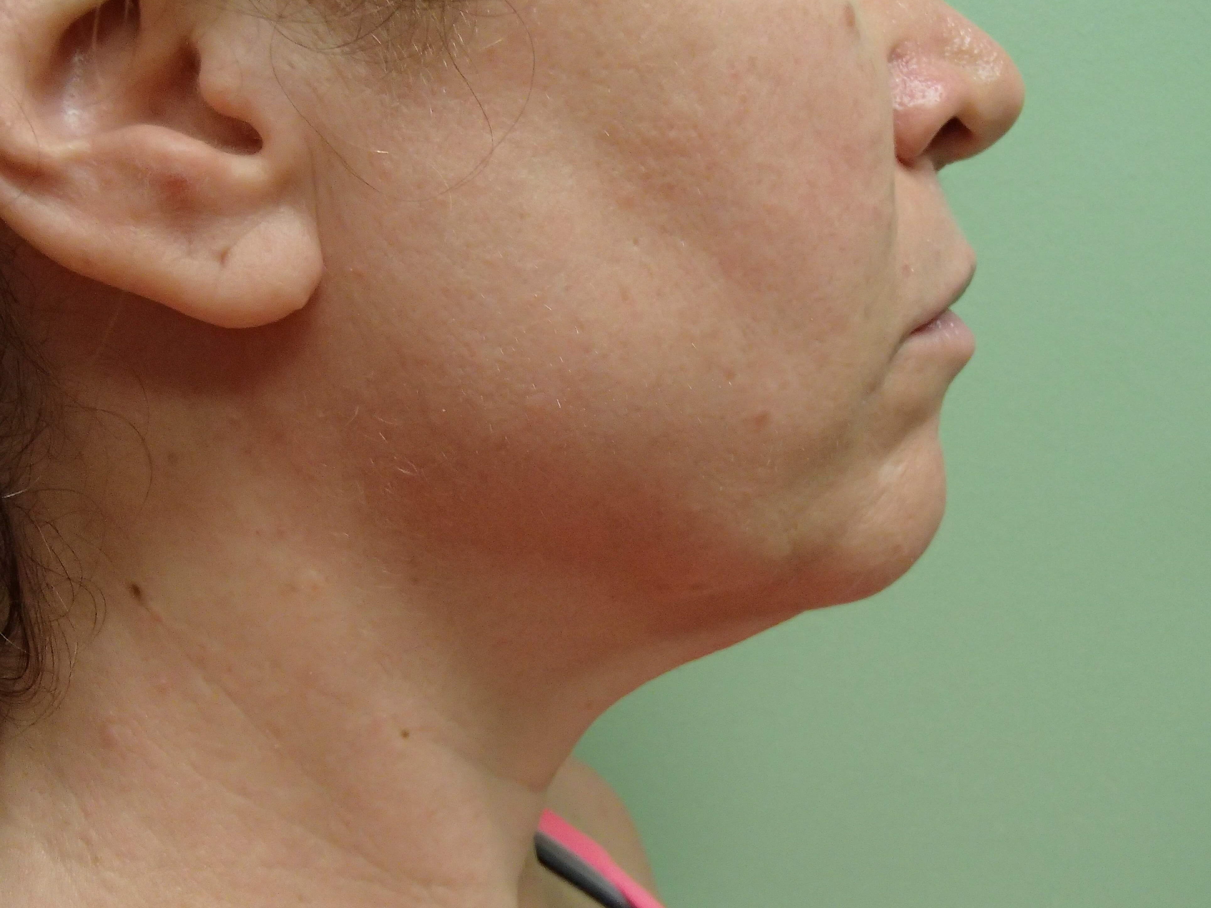 Necklift Before