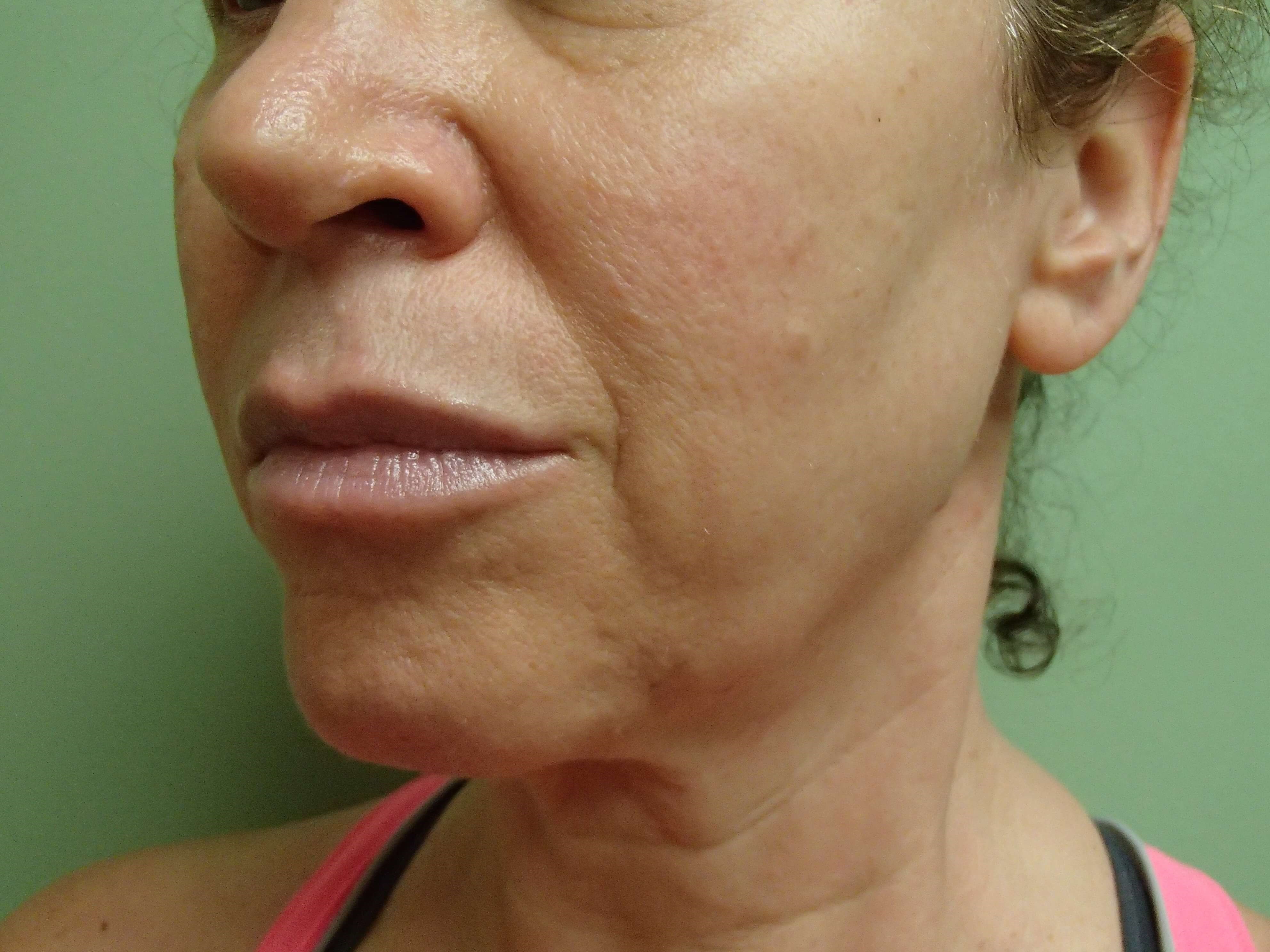 Necklift Before