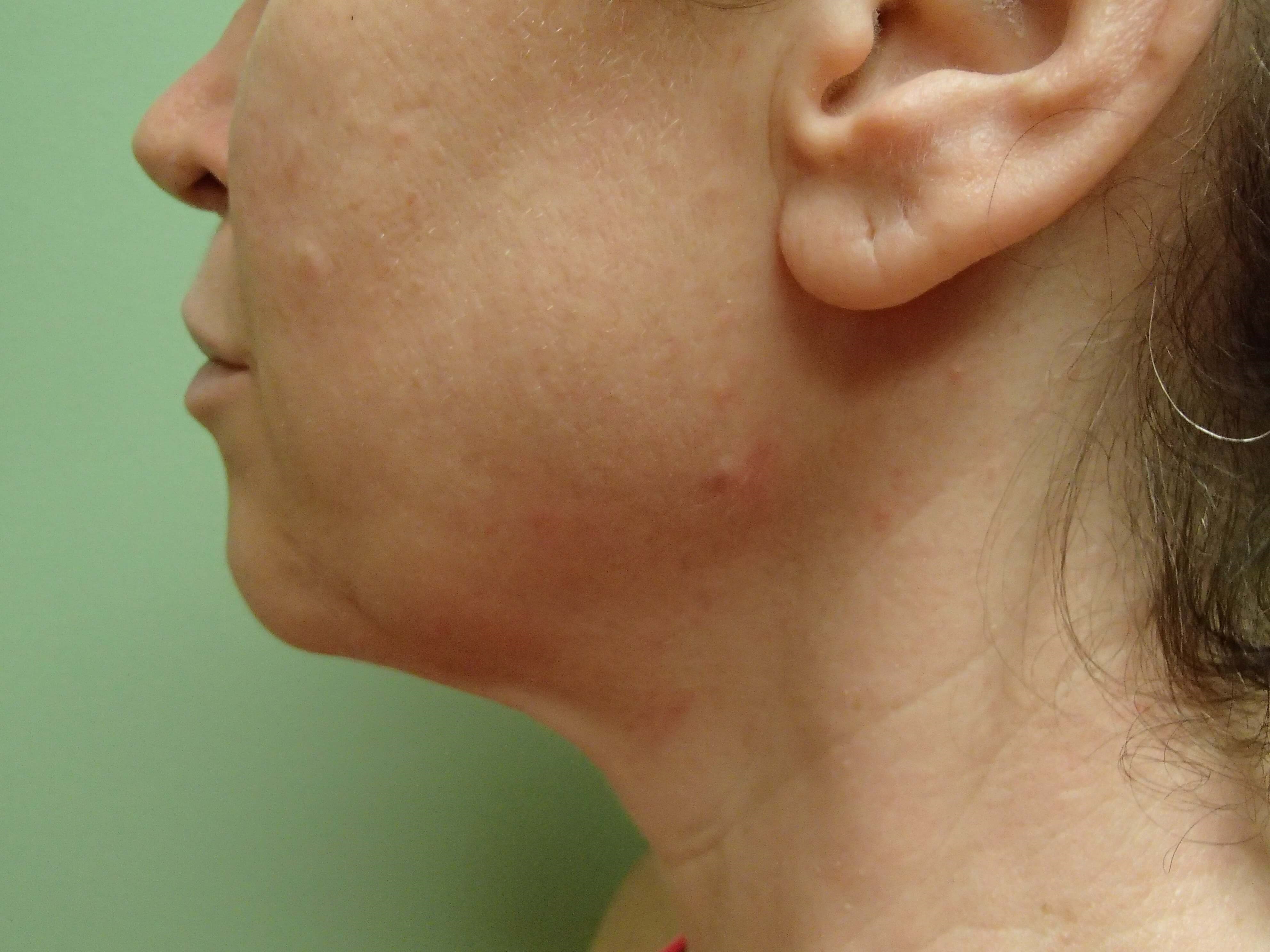 Necklift Before
