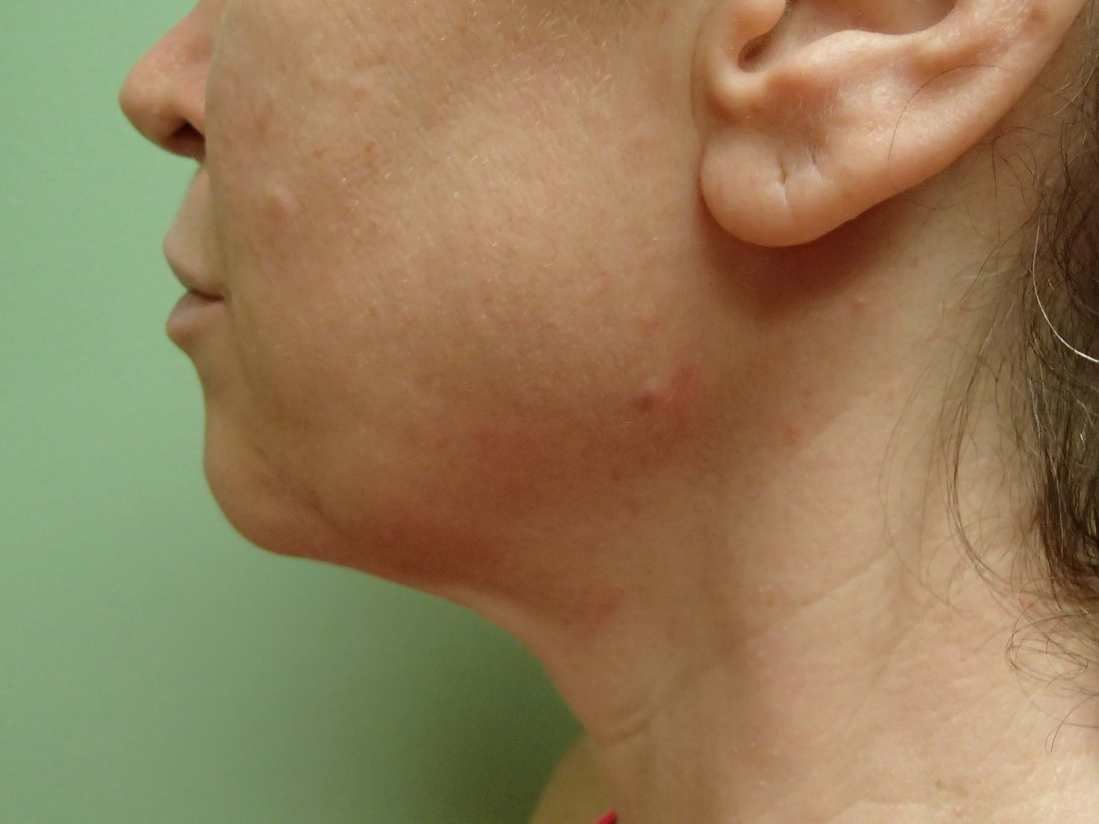 Necklift Before