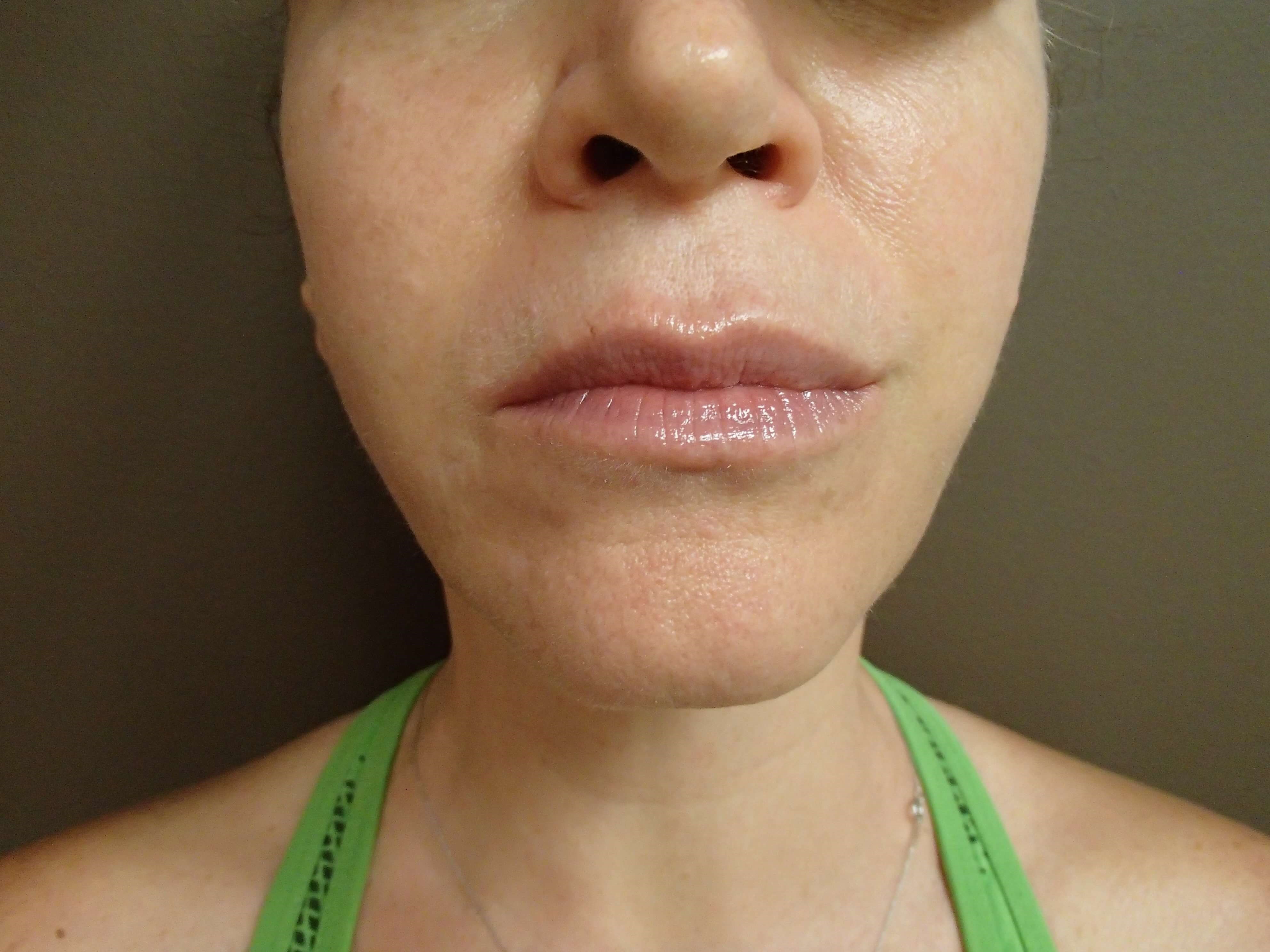 Necklift After