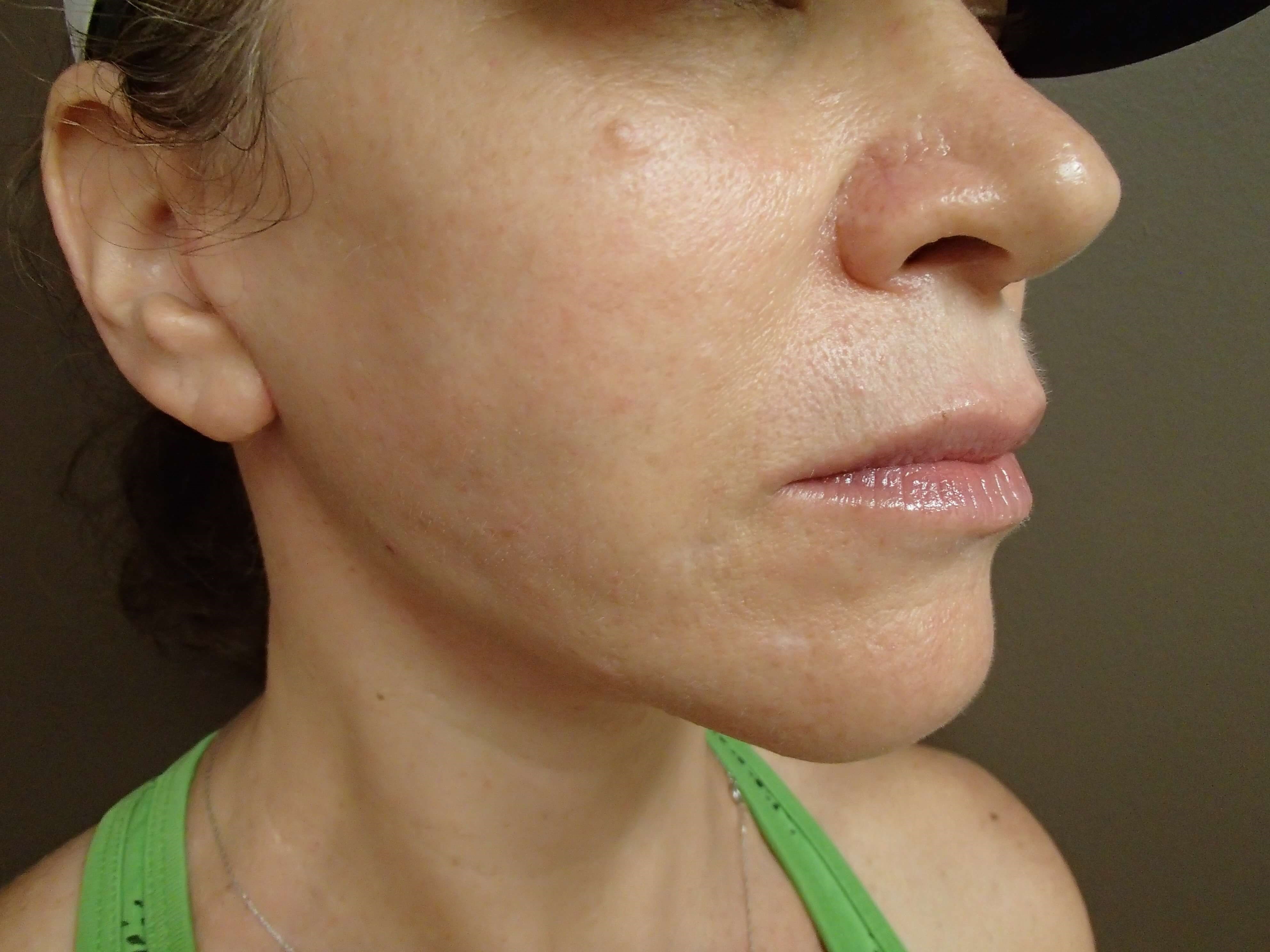Necklift After