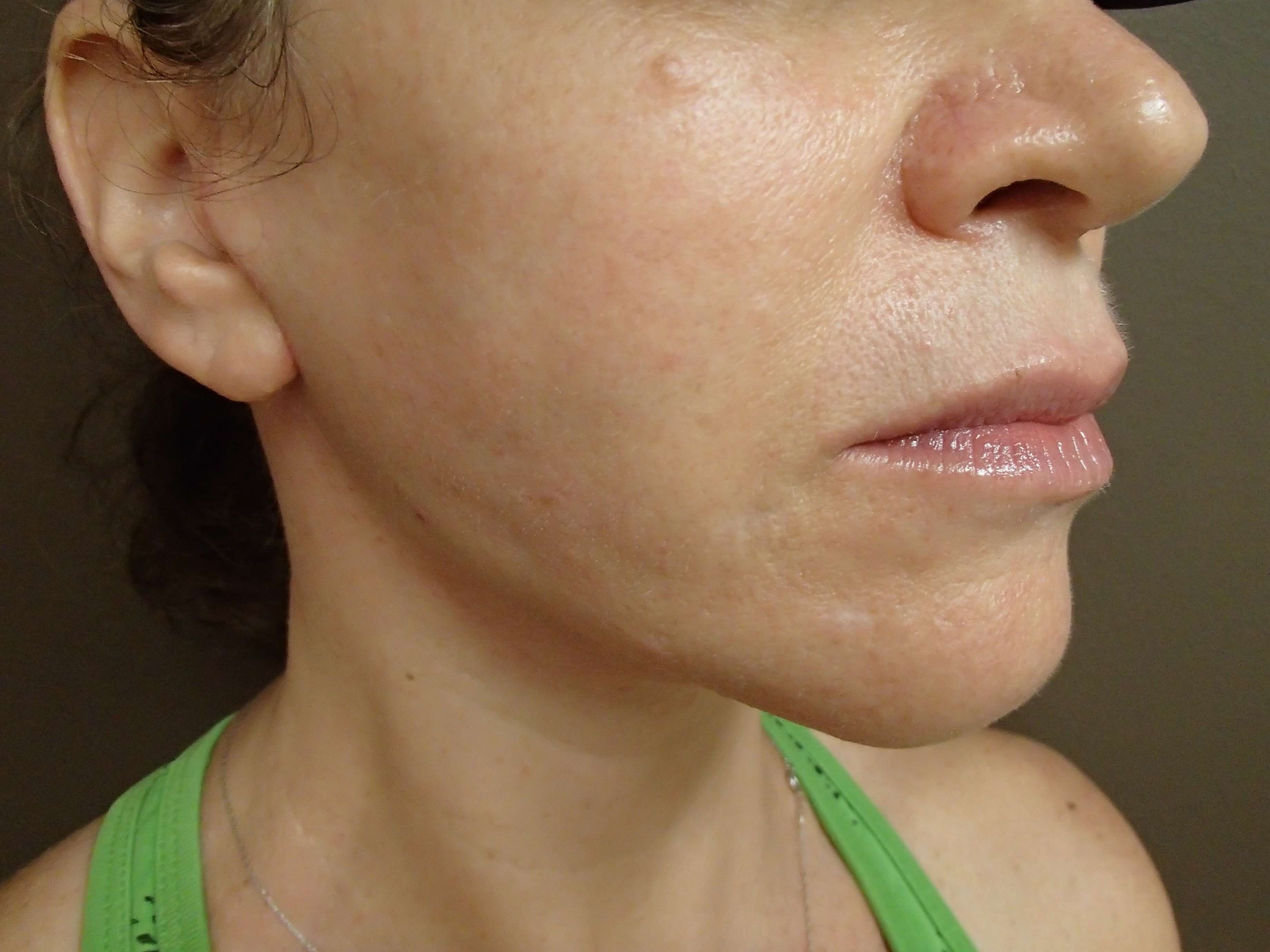 Necklift After