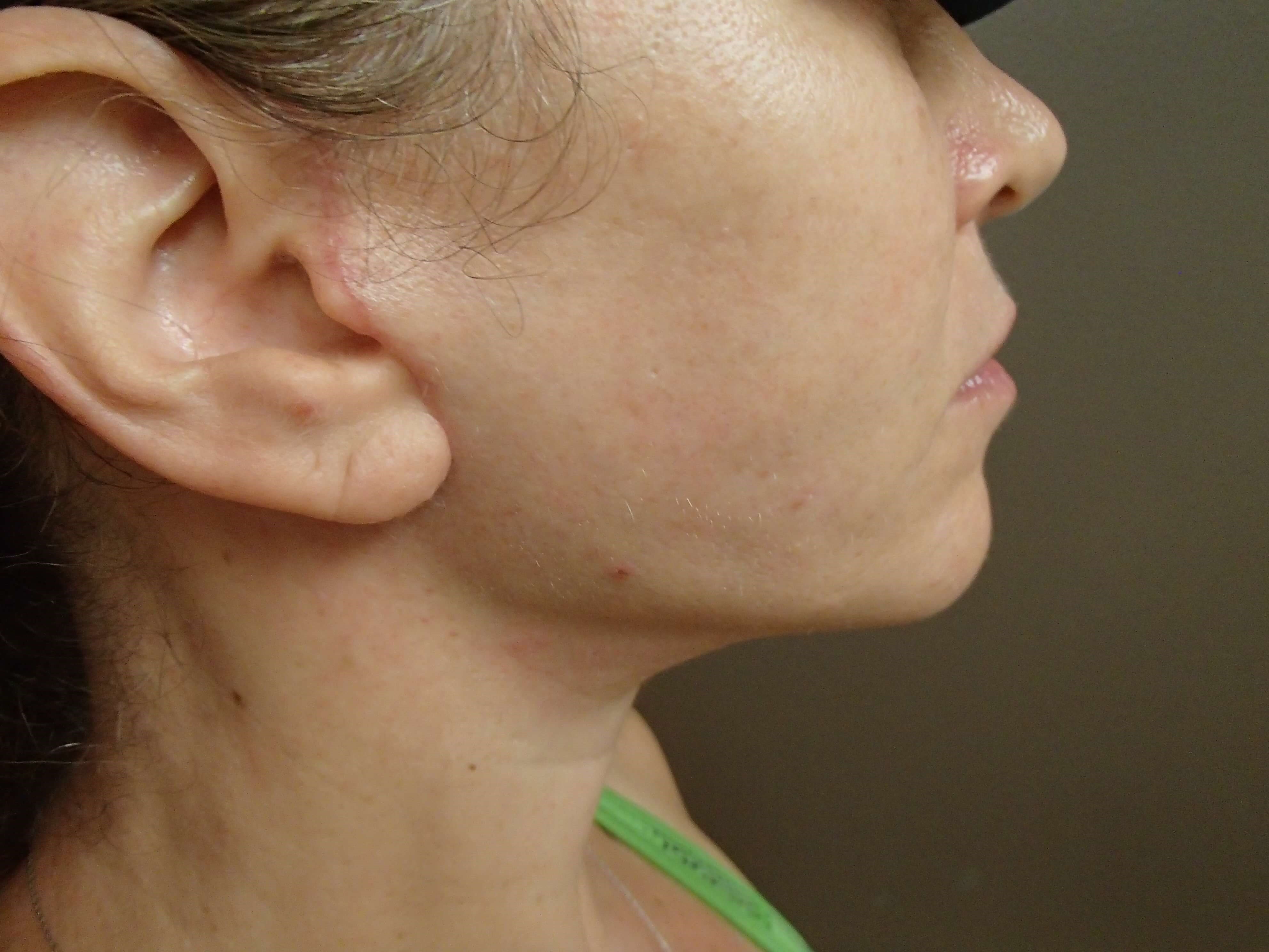 Necklift After