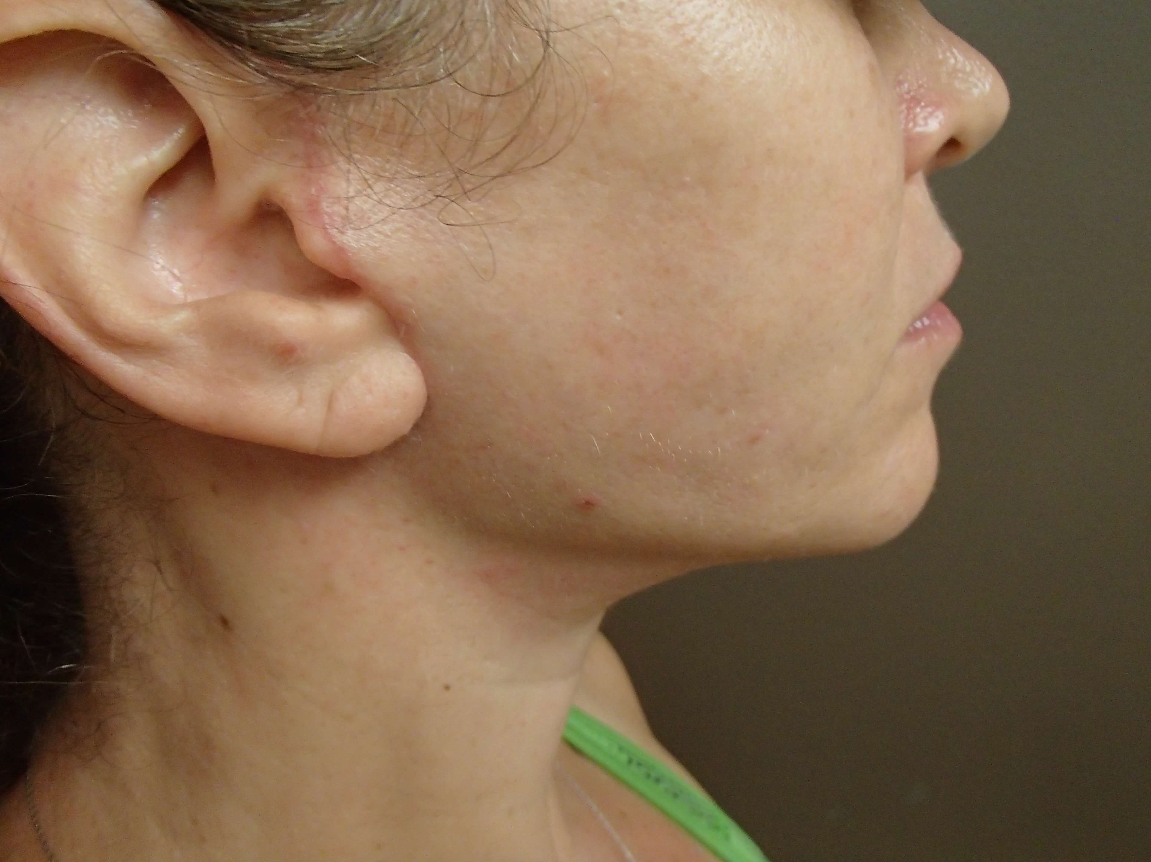 Necklift After