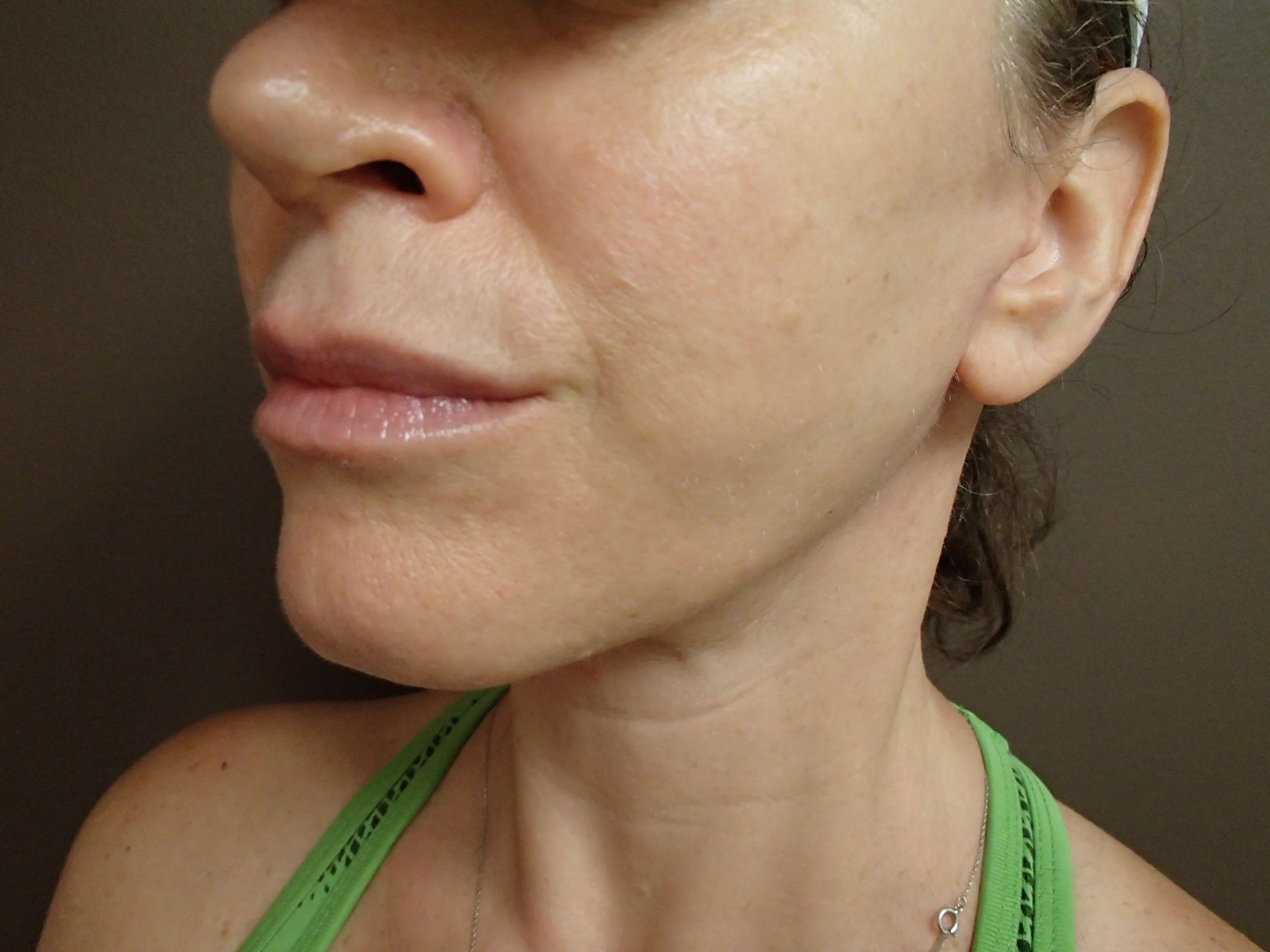 Necklift After