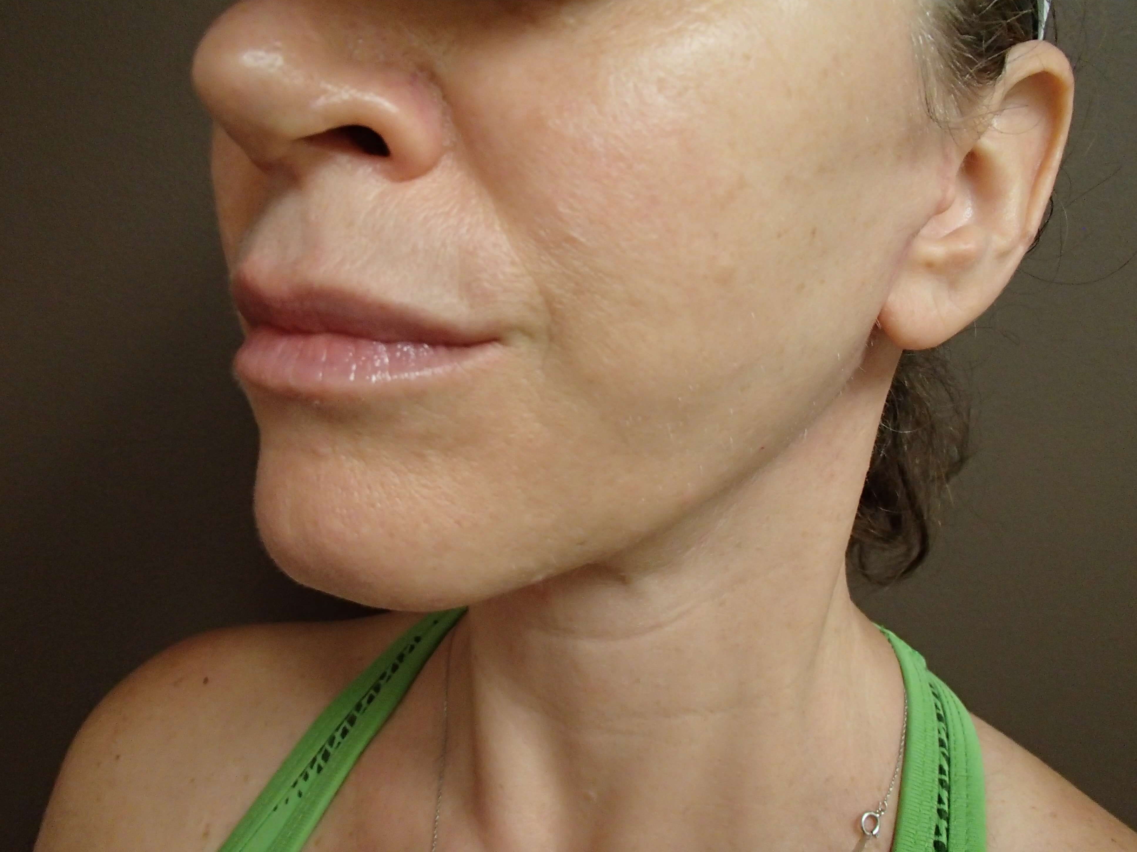 Necklift After