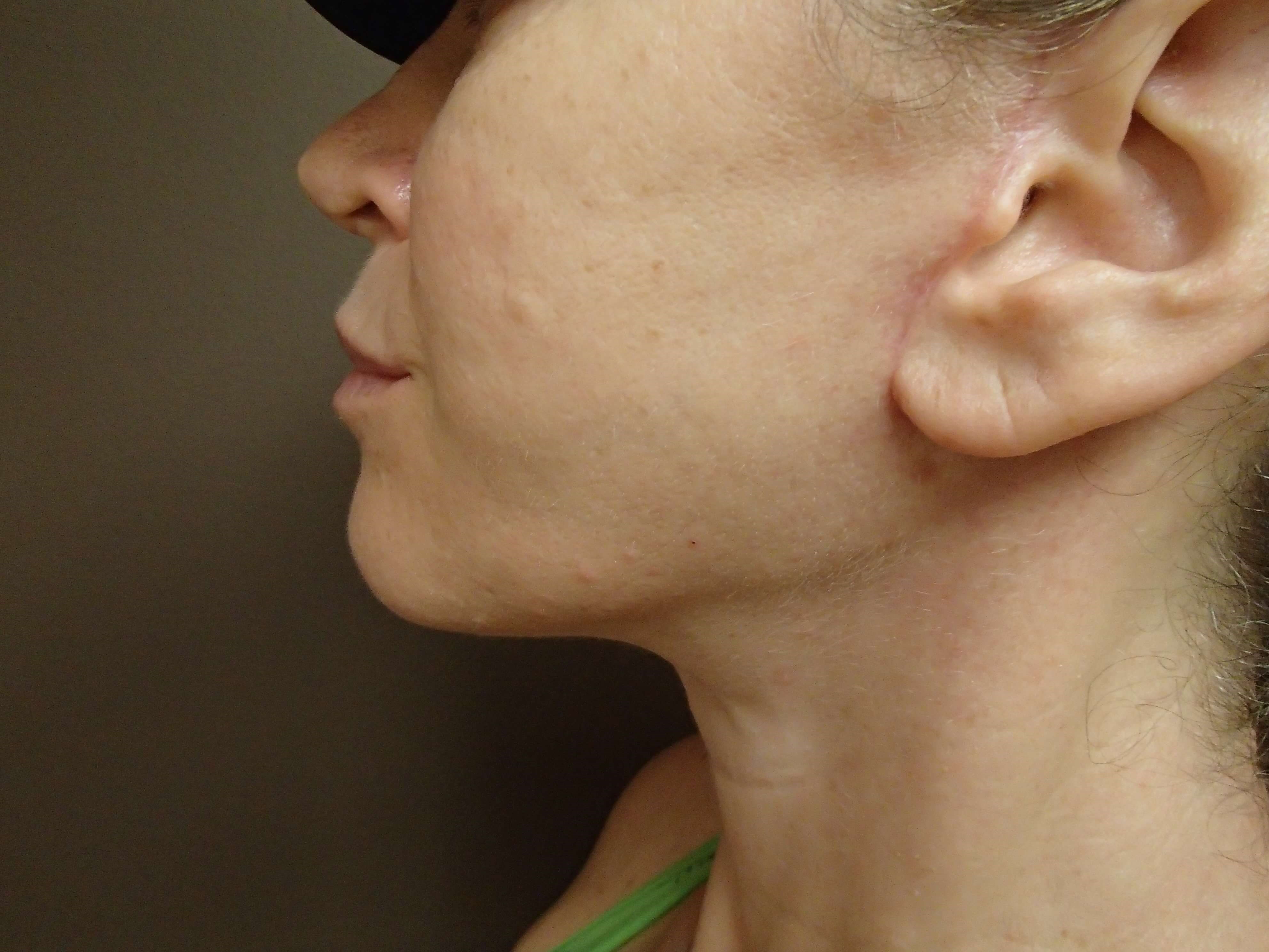 Necklift After