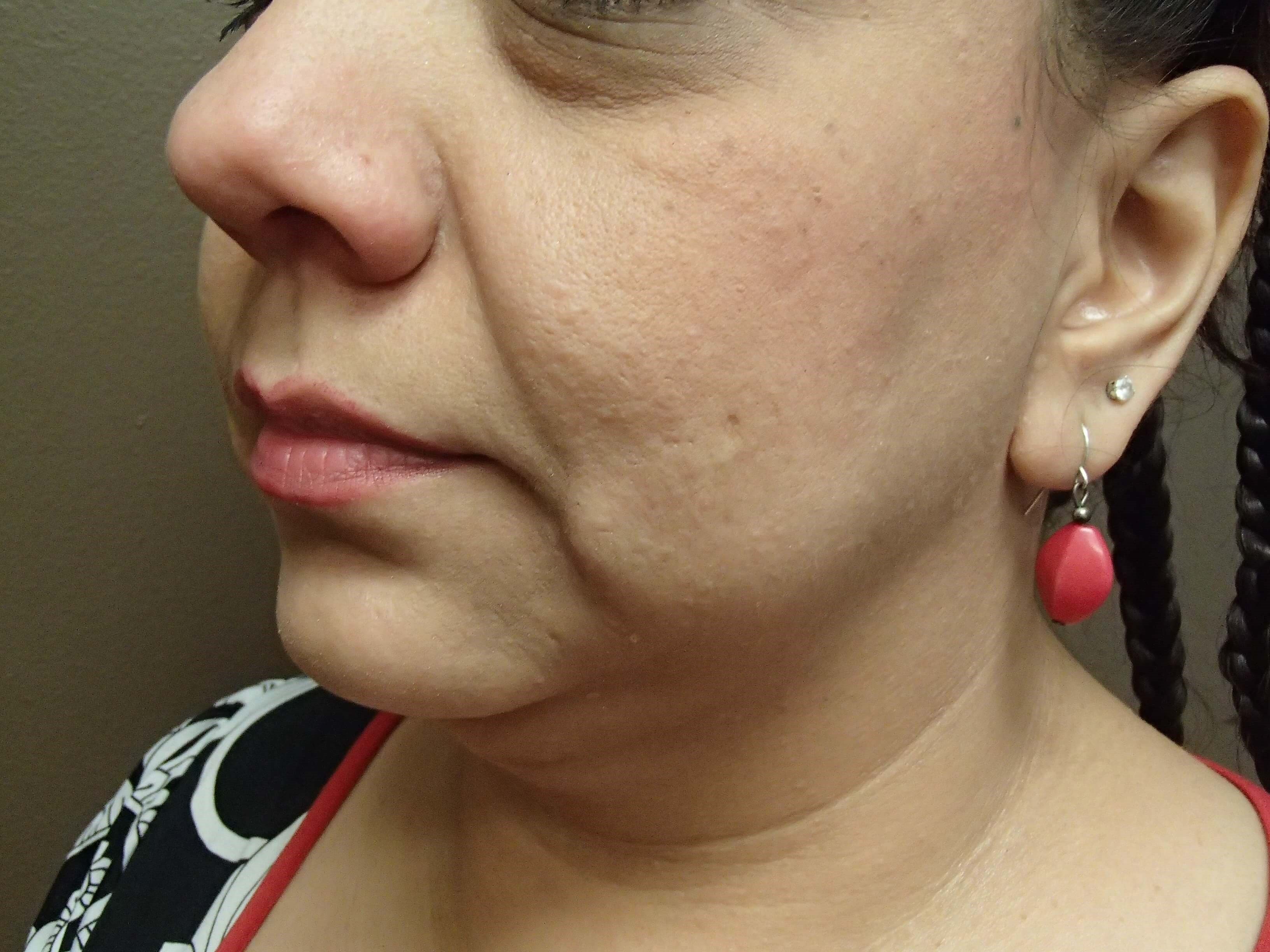 Necklift Before