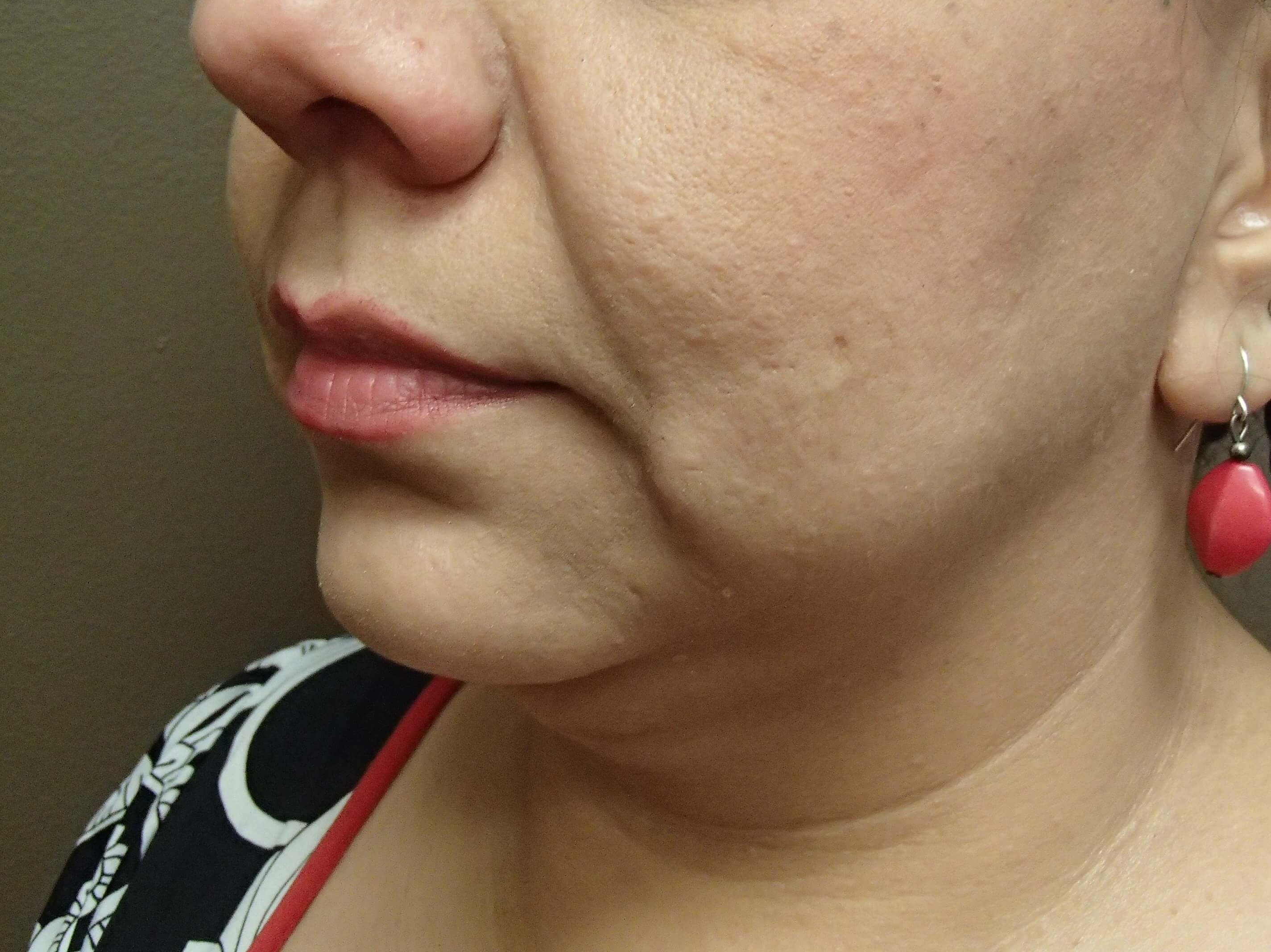Necklift Before