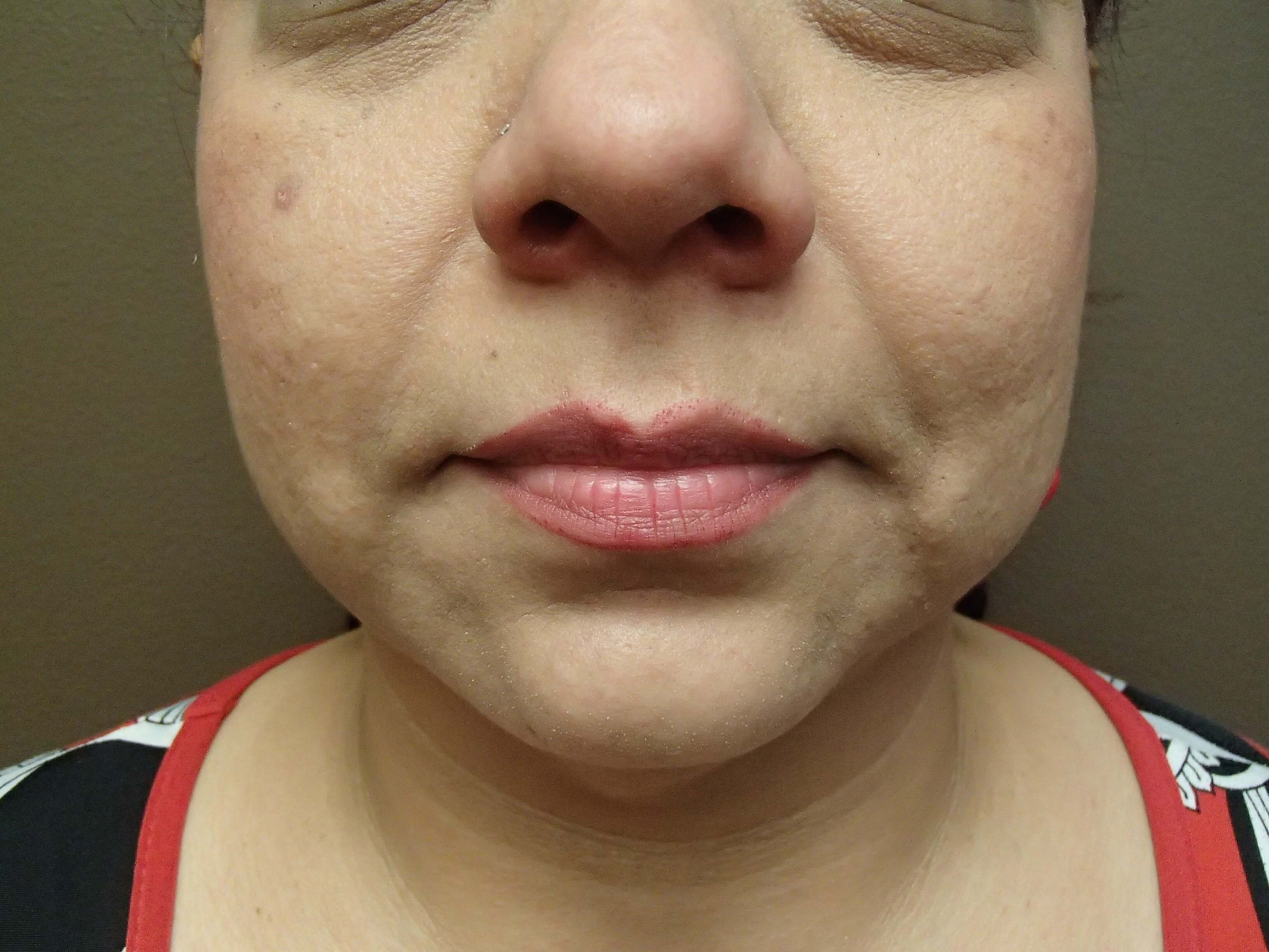 Necklift Before