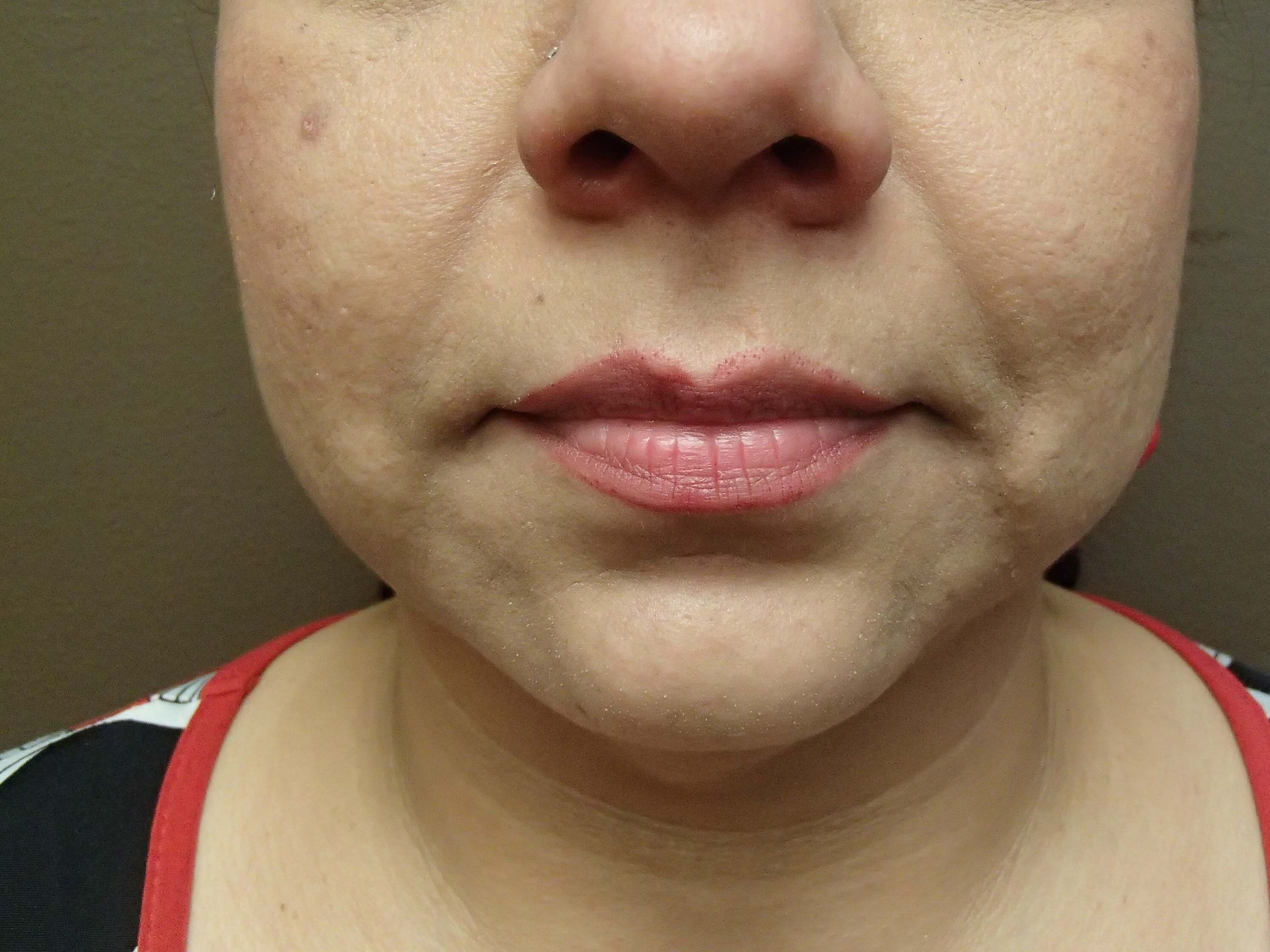 Necklift Before