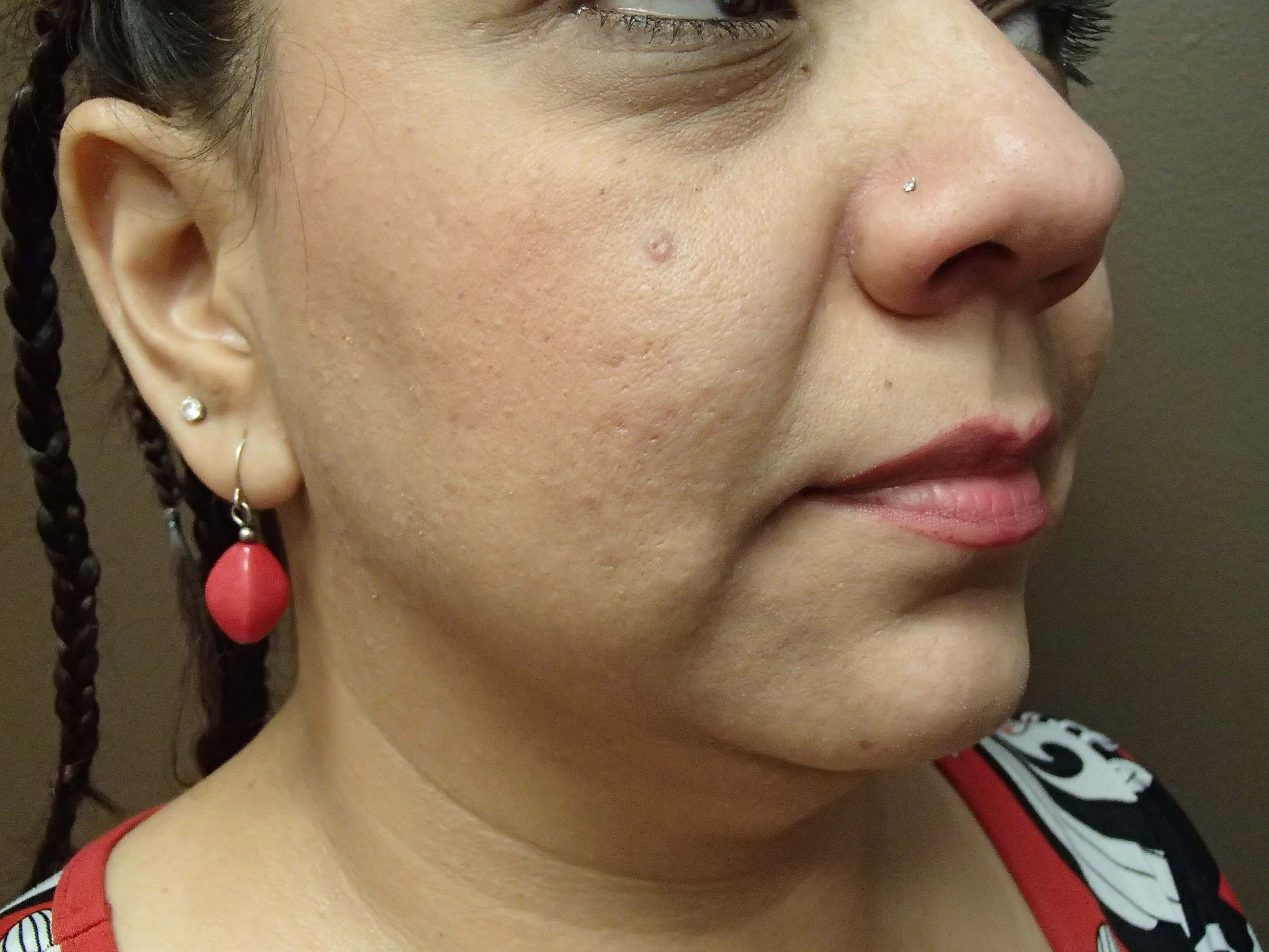 Necklift Before