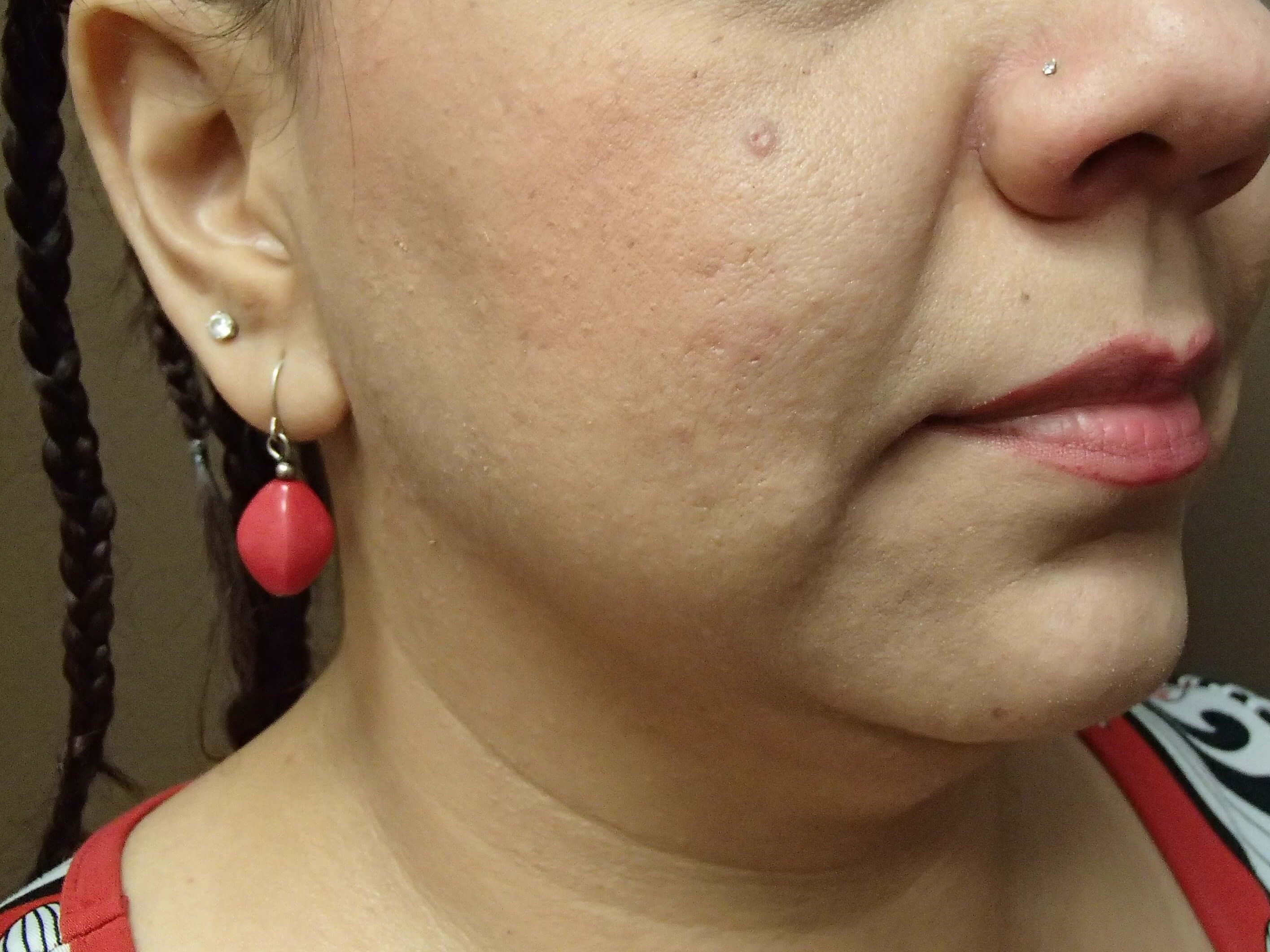 Necklift Before