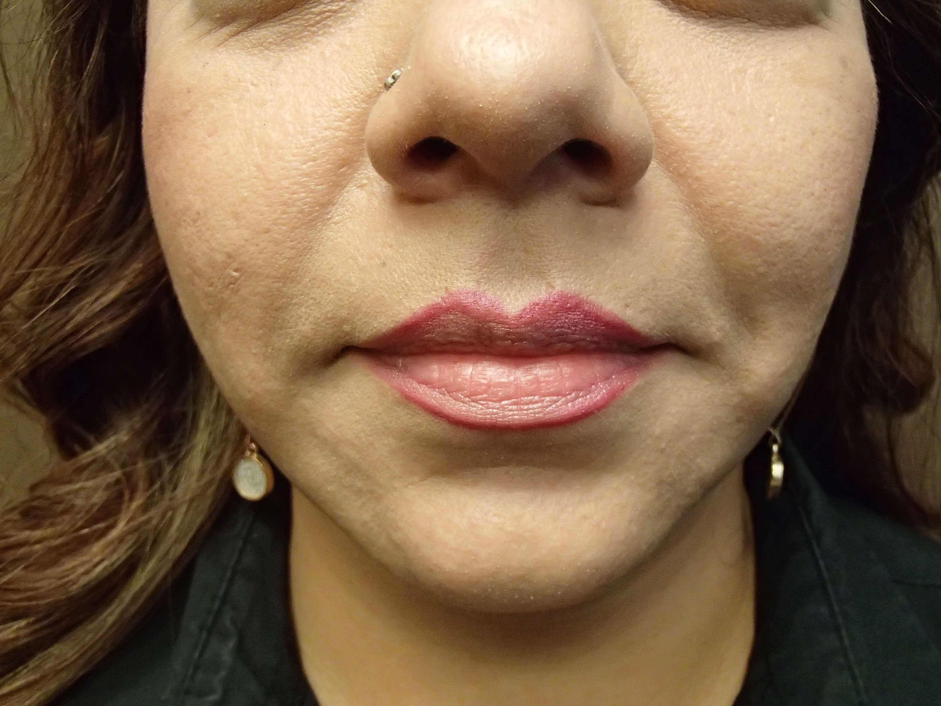 Necklift After