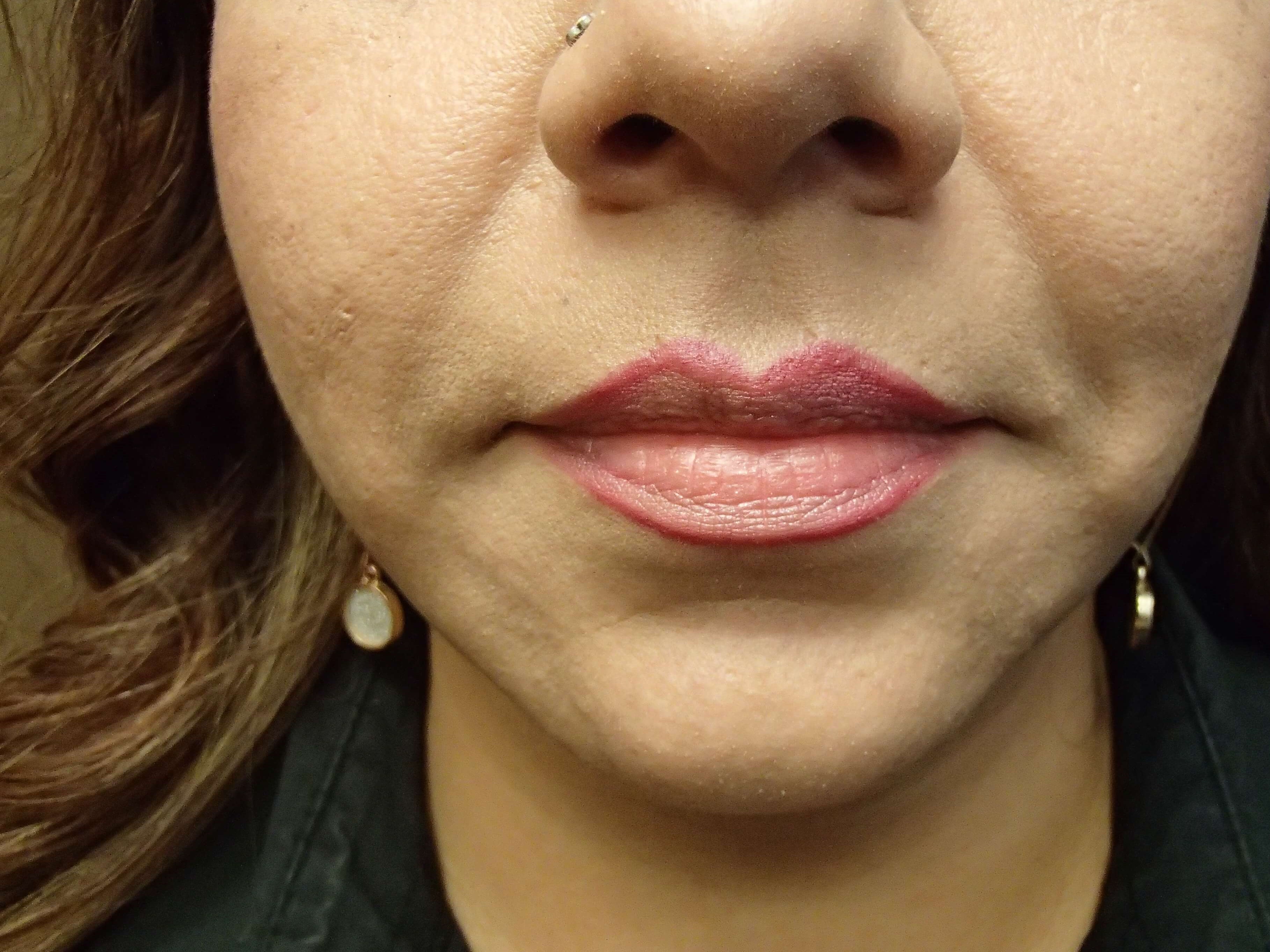 Necklift After